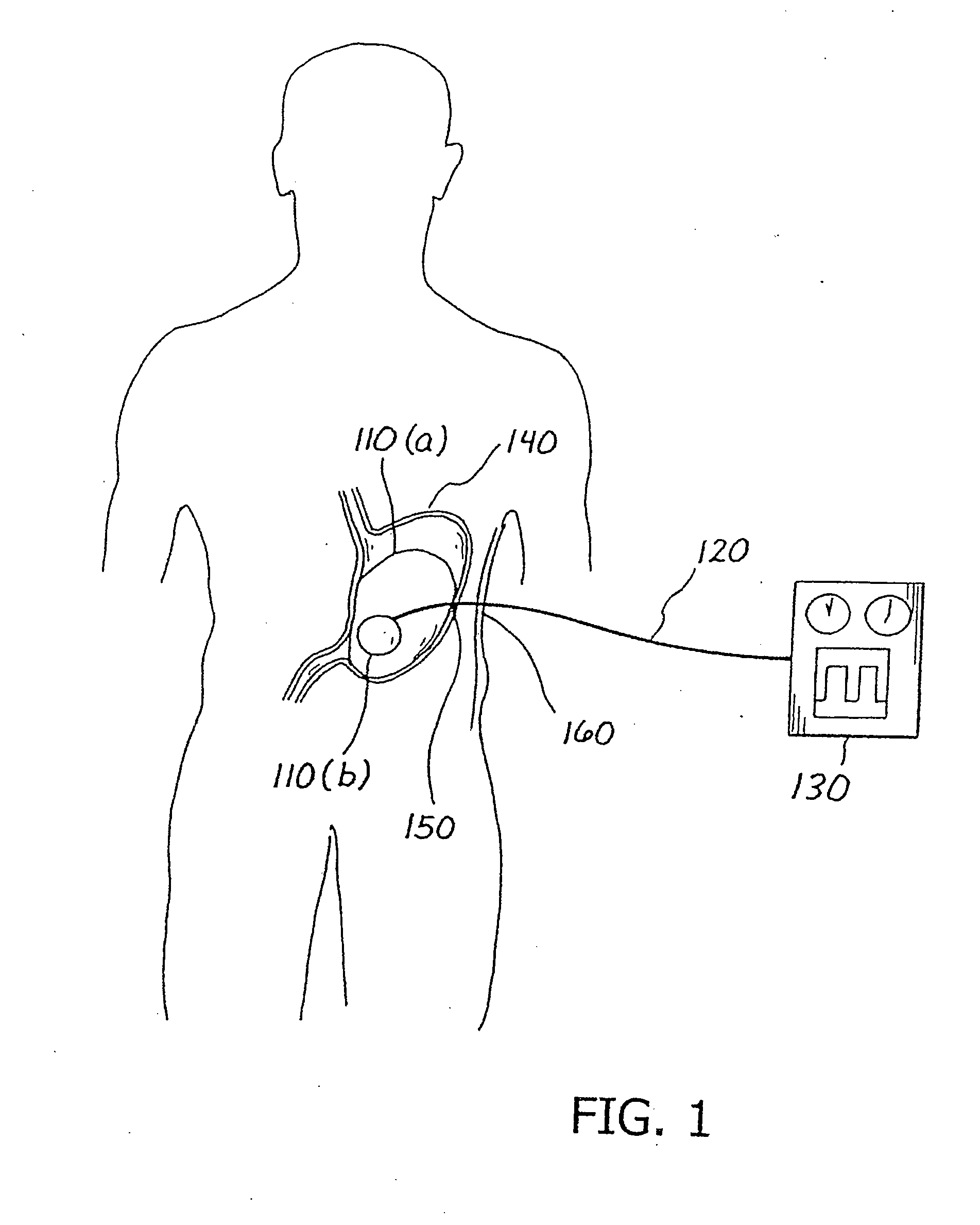 Balloon system and methods for treating obesity