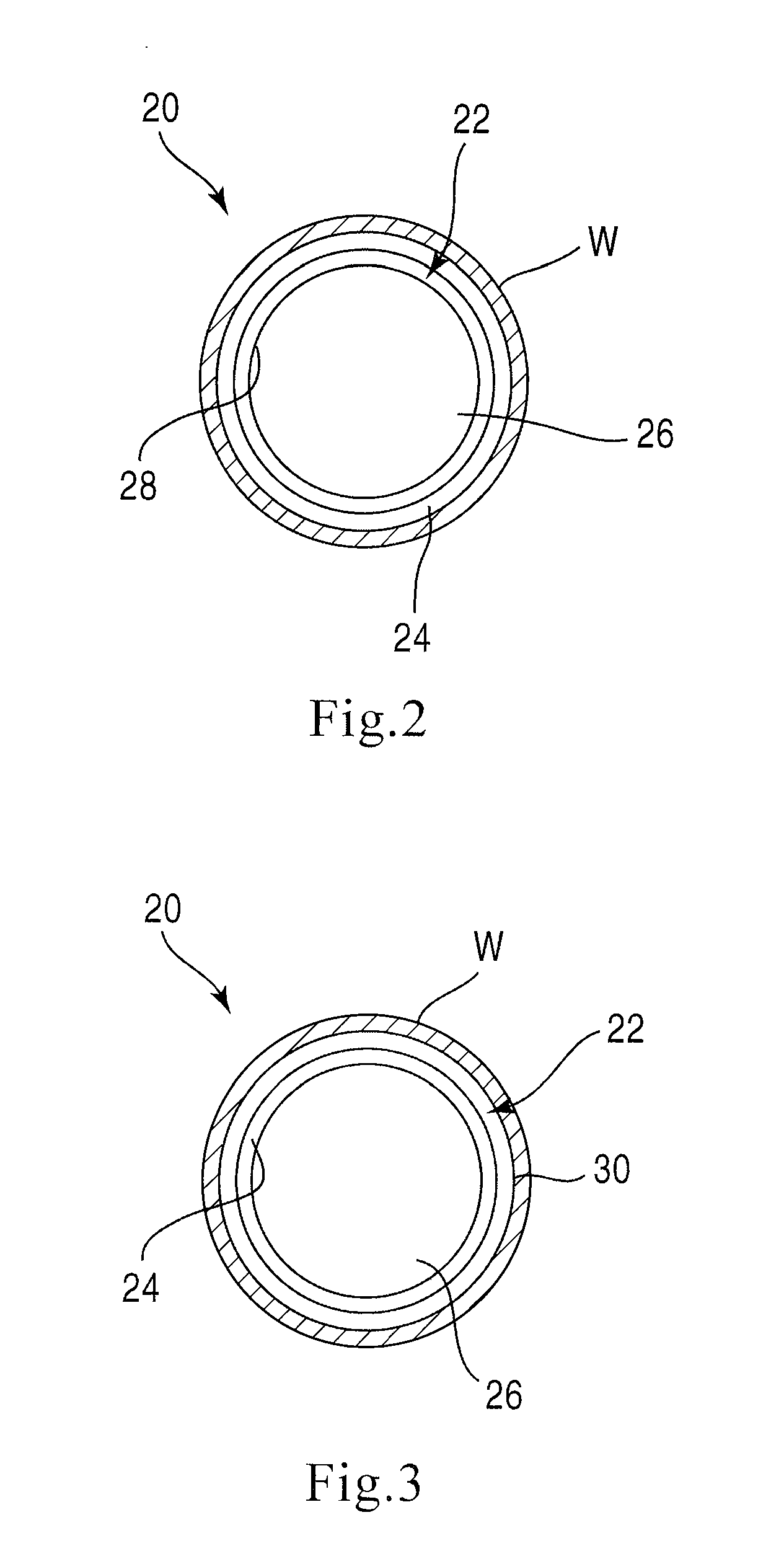 Bioabsorbable stent