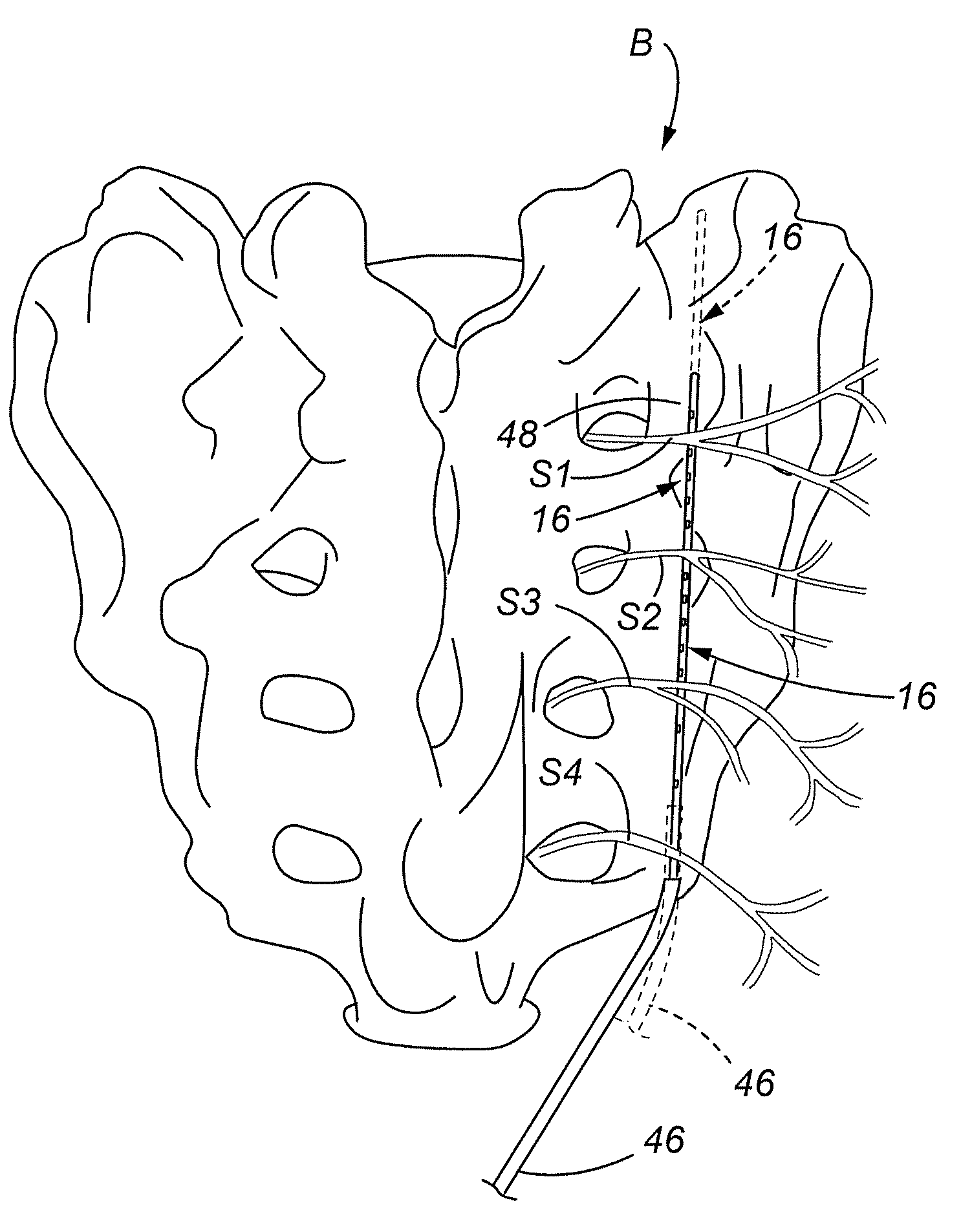 Combination electrical stimulating and infusion medical device and method