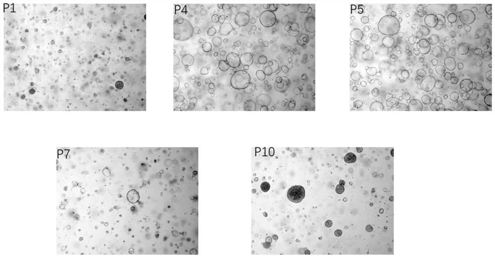 Continuous culture method and culture medium for primary hepatocellular carcinoma organoids