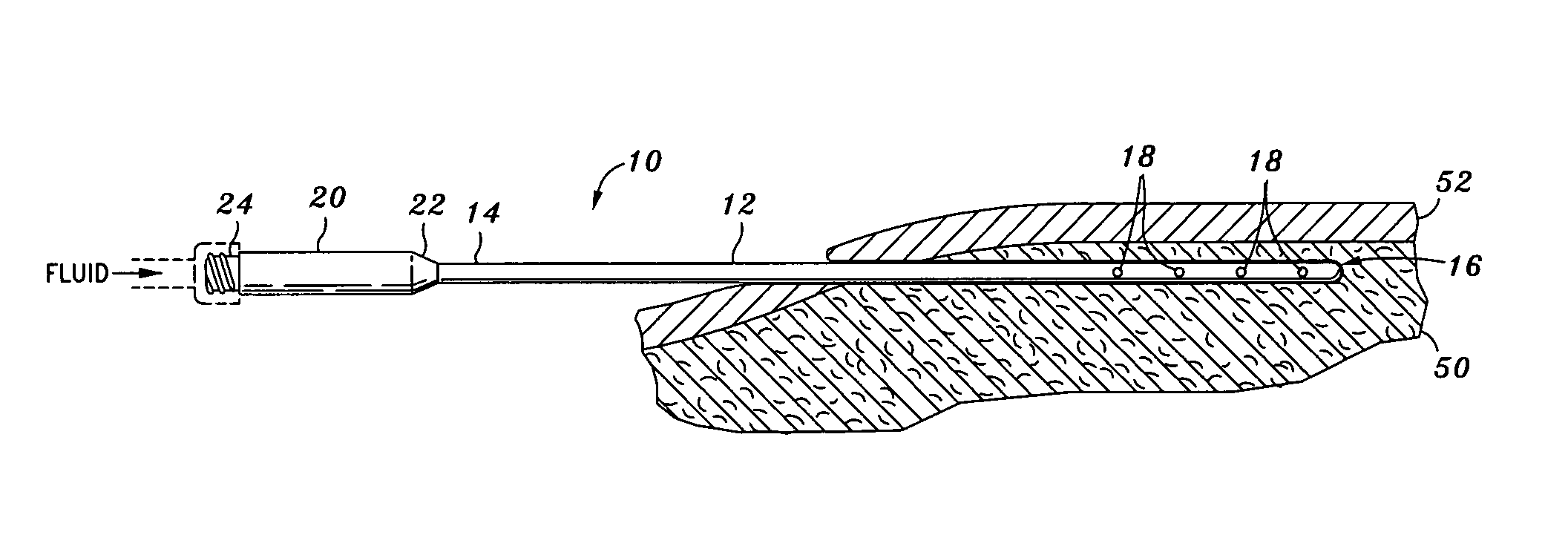 Infiltration cannula