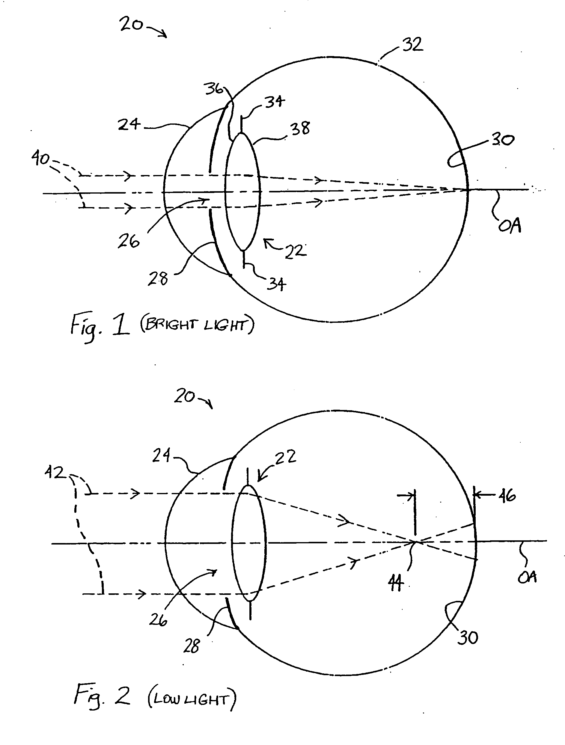 Multi-zonal monofocal intraocular lens for correcting optical aberrations