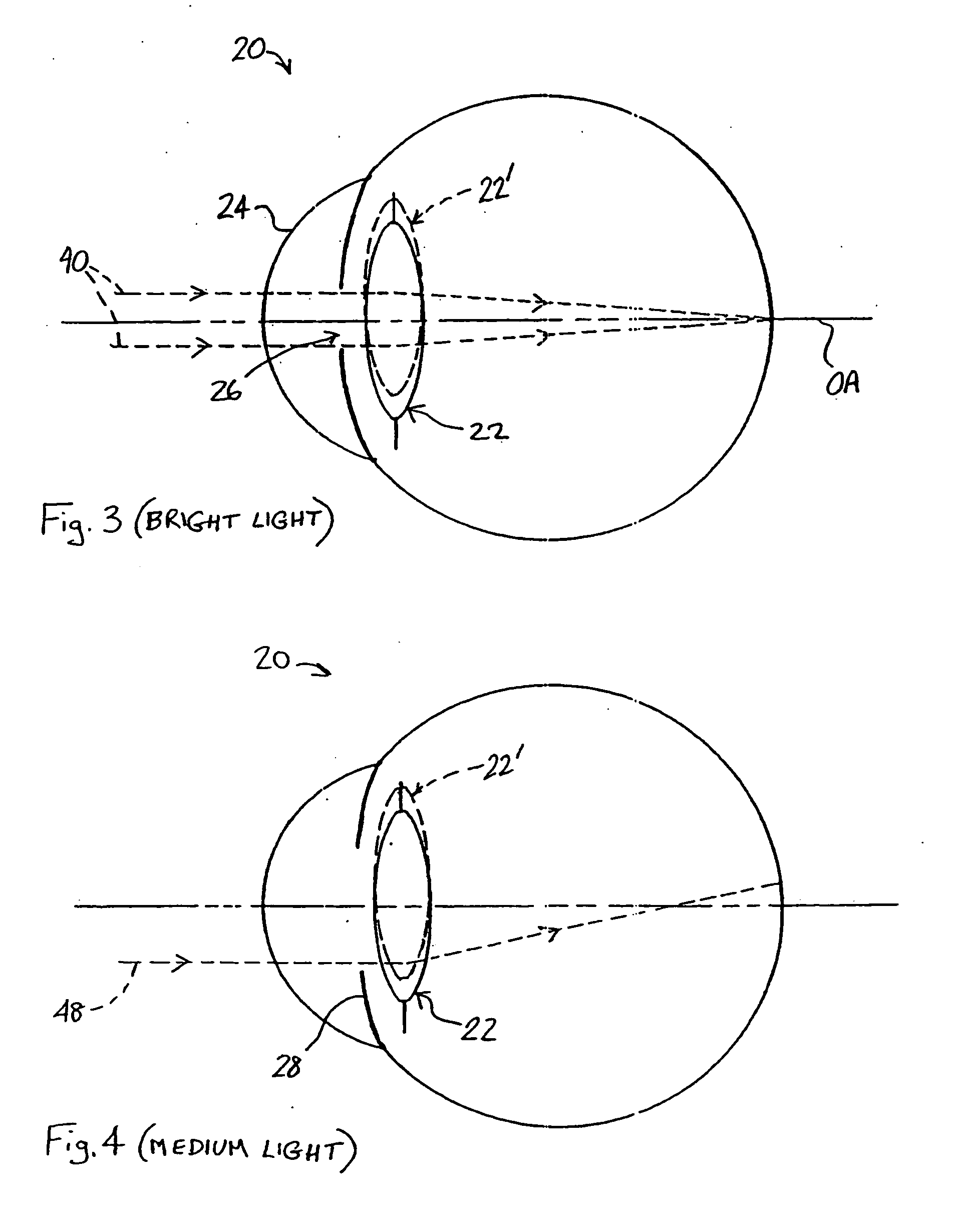 Multi-zonal monofocal intraocular lens for correcting optical aberrations