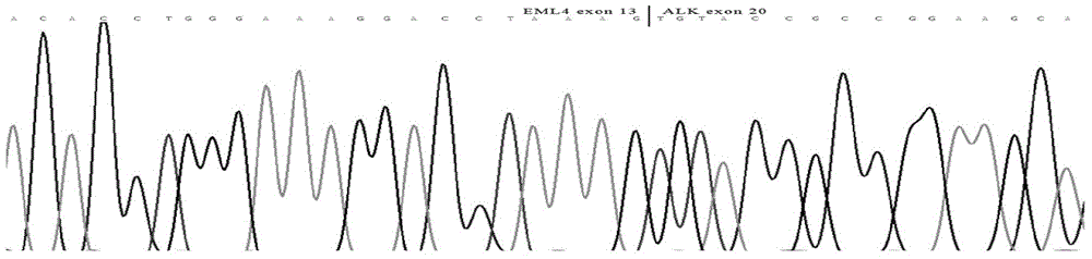 EML4-ALK (Echinoderm microtubule associated protein like4-anaplastic lymphoma kinase) fusion gene fluorescent quantitative PCR (polymerase chain reaction) assay kit