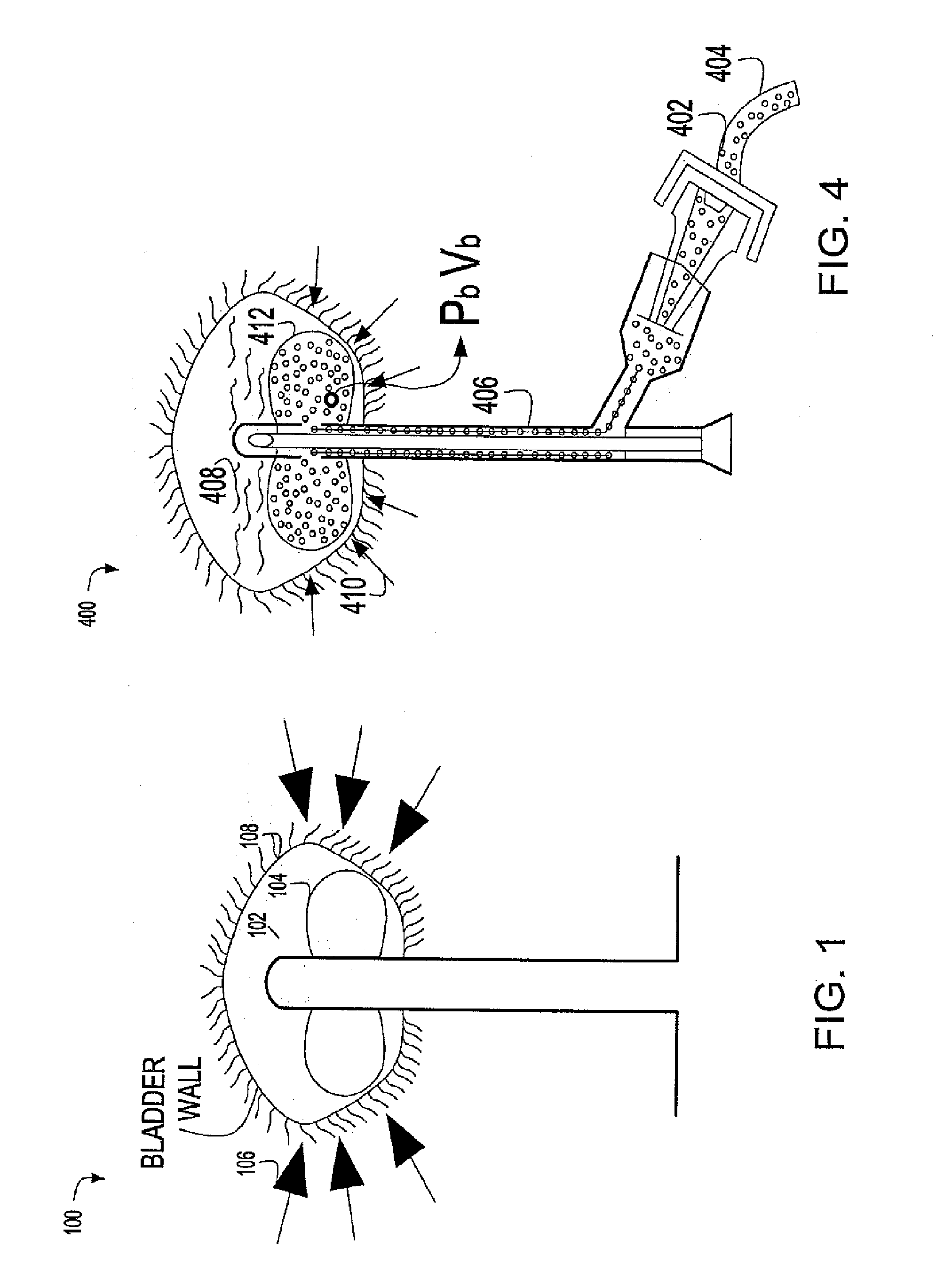 Continuous intra-abdominal pressure monitoring system