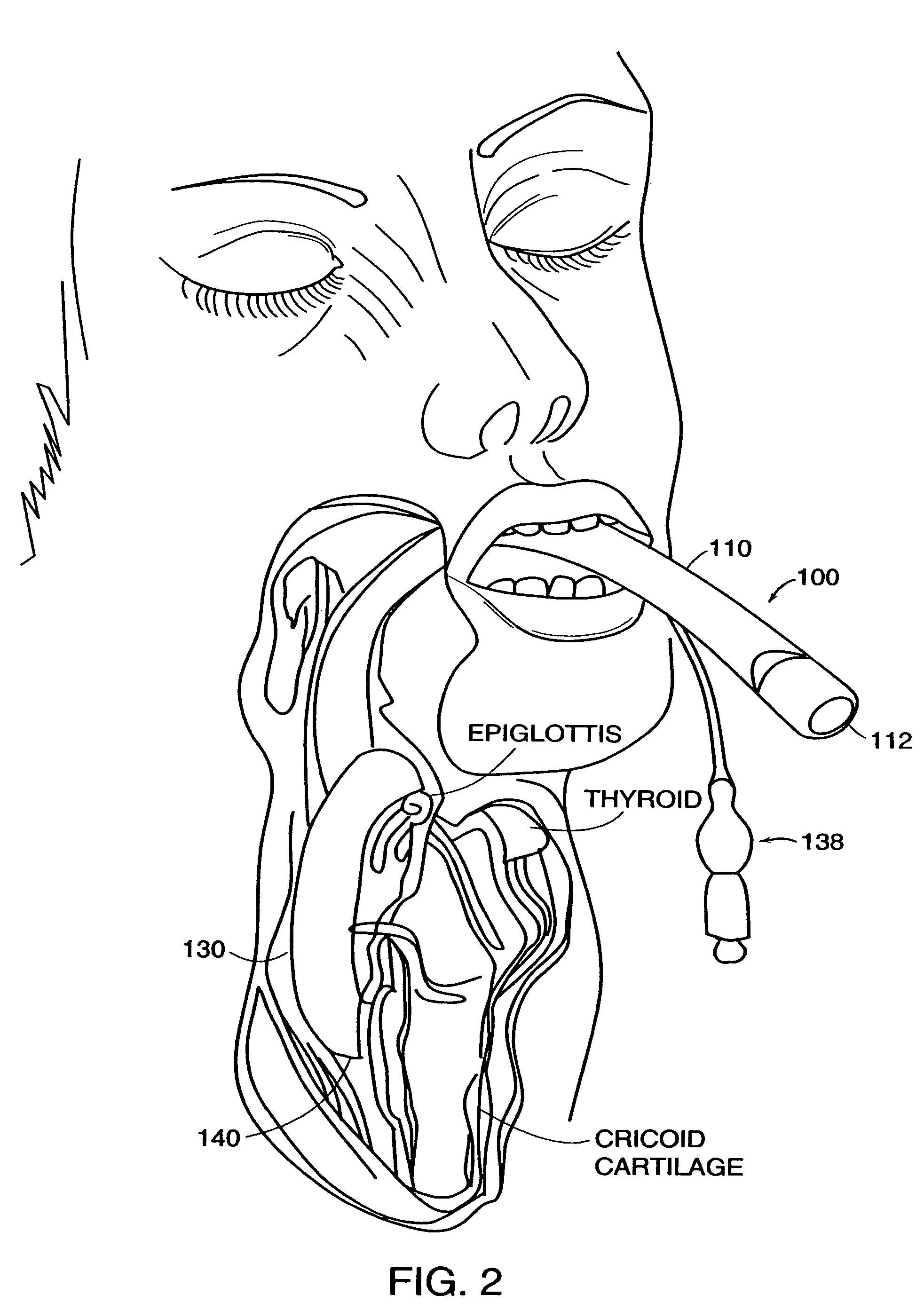 Disposable LMA