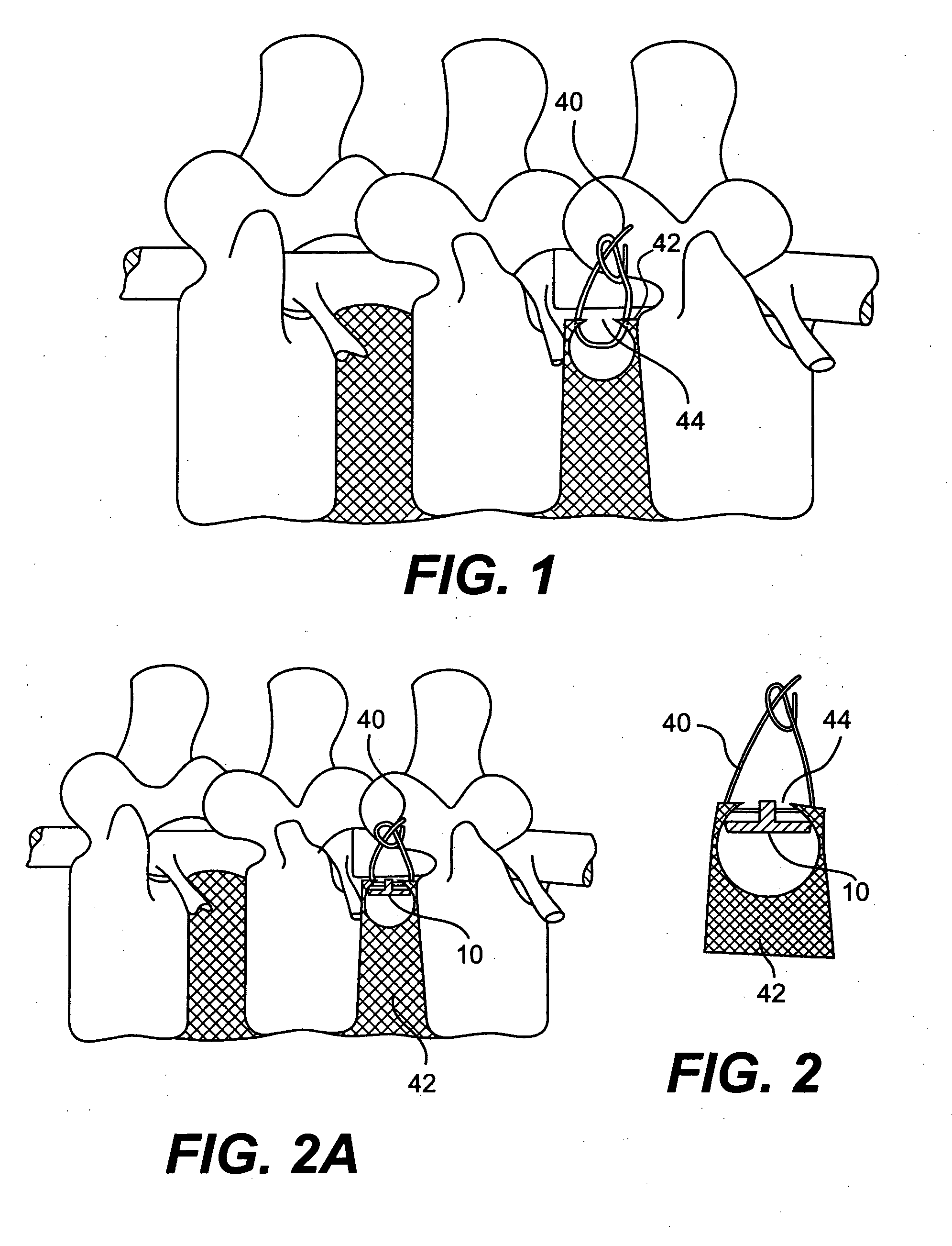 Method and apparatus for enhanced delivery of treatment device to the intervertebral disc annulus