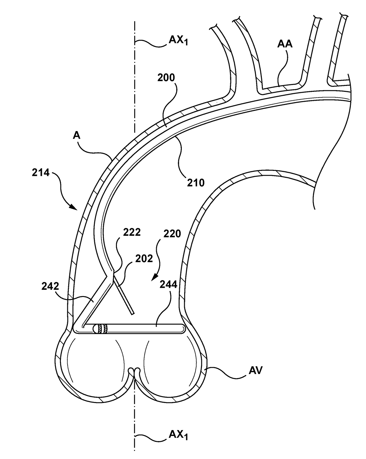 Transcatheter guidewire delivery systems, catheter assemblies for guidewire delivery, and methods for percutaneous guidewire delivery across heart valves