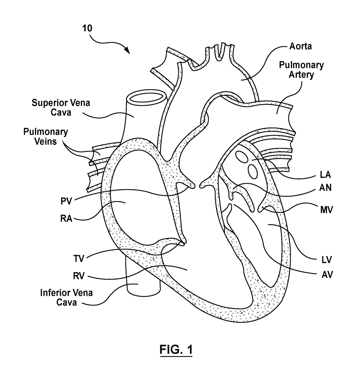 Transcatheter guidewire delivery systems, catheter assemblies for guidewire delivery, and methods for percutaneous guidewire delivery across heart valves