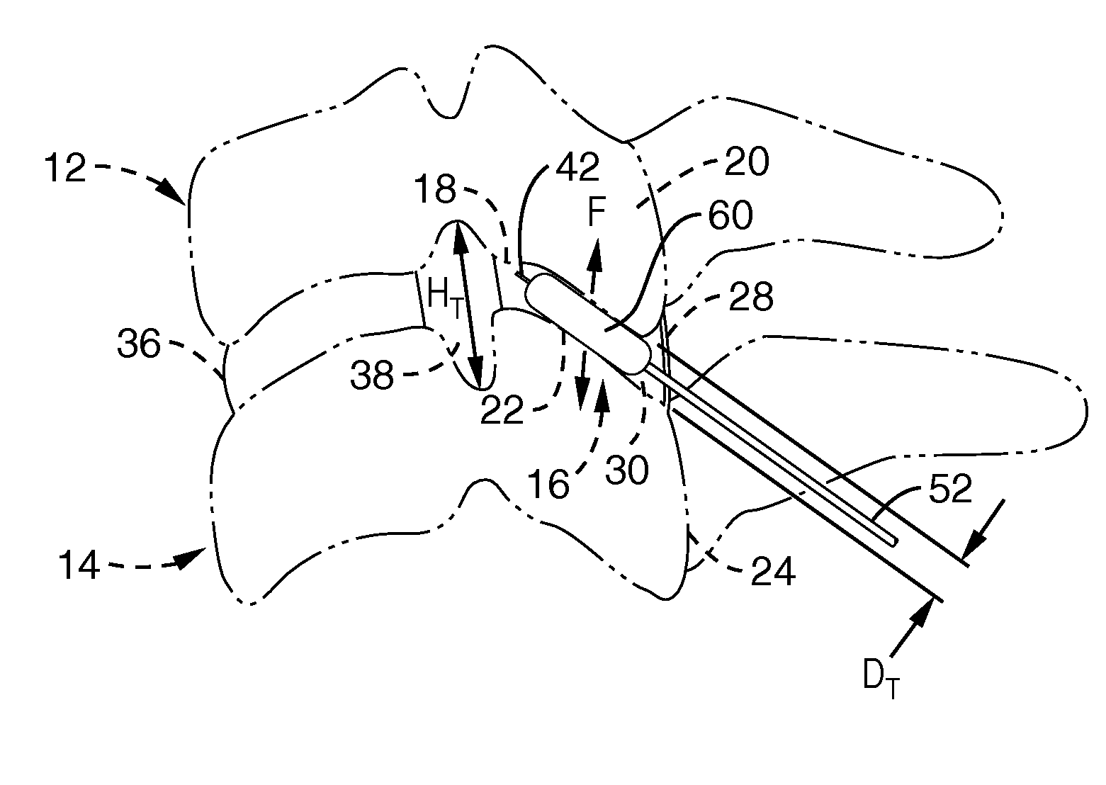 Cervical distraction device