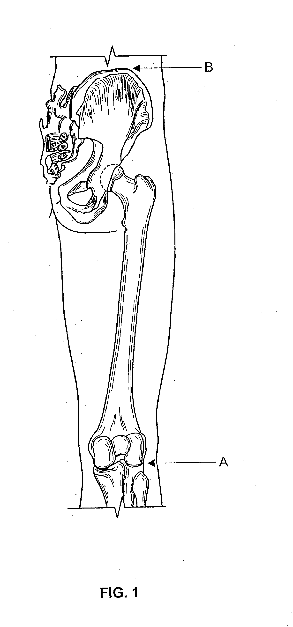 Noninvasive methods, apparatus, kits, and systems for intraoperative position and length determination