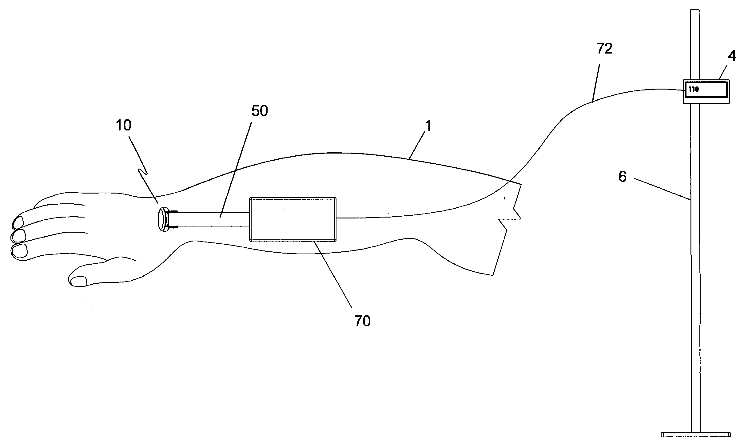 Temperature-compensated in-vivo sensor