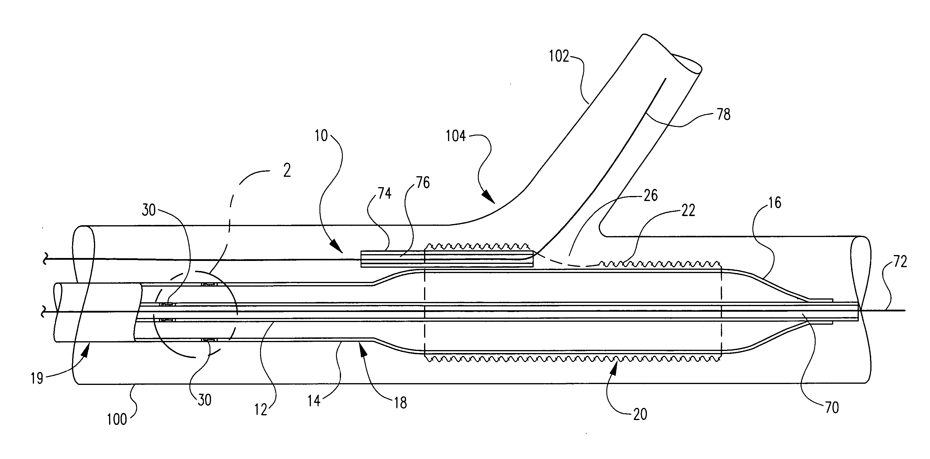 Bifurcation delivery system