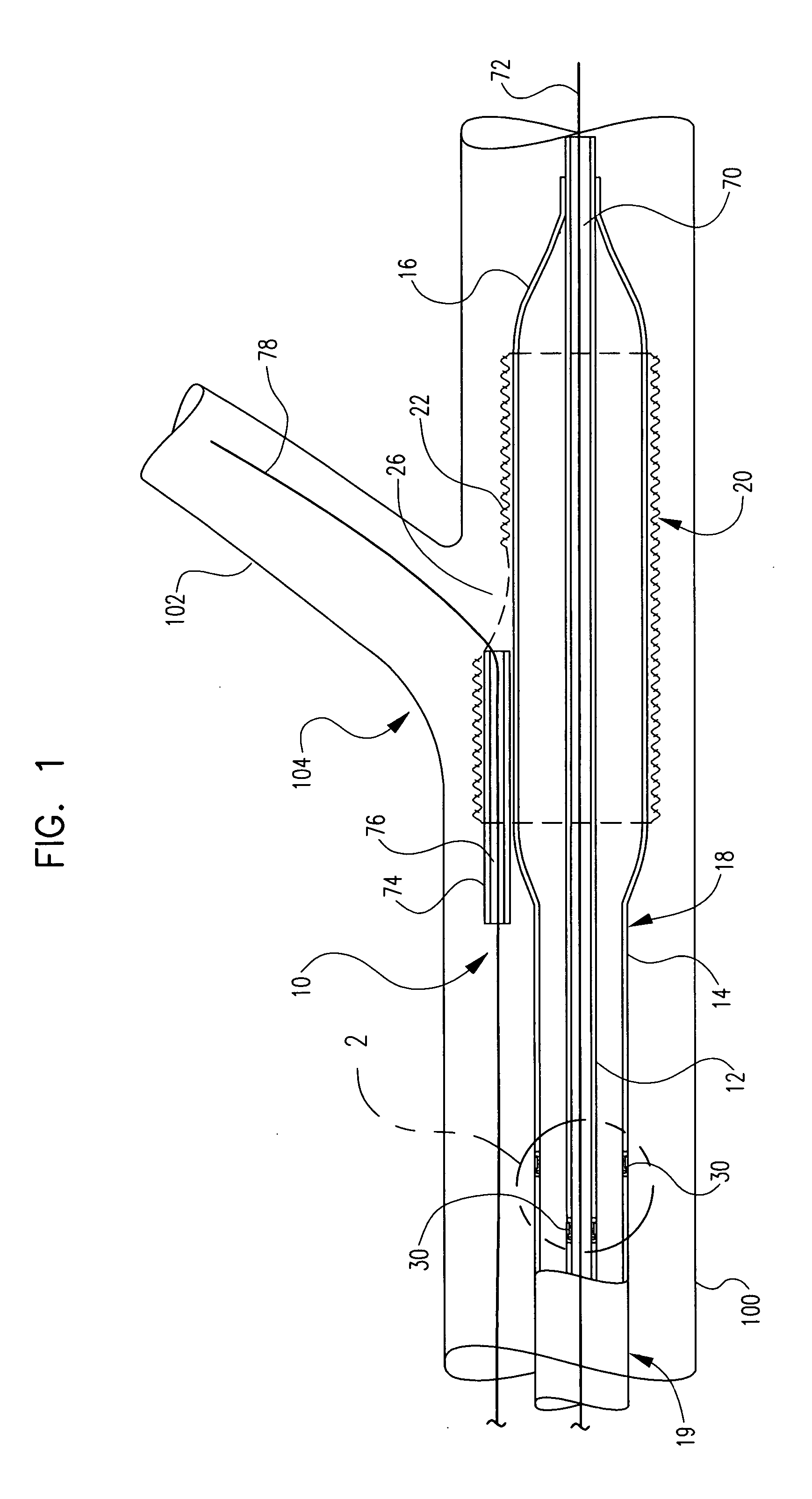 Bifurcation delivery system