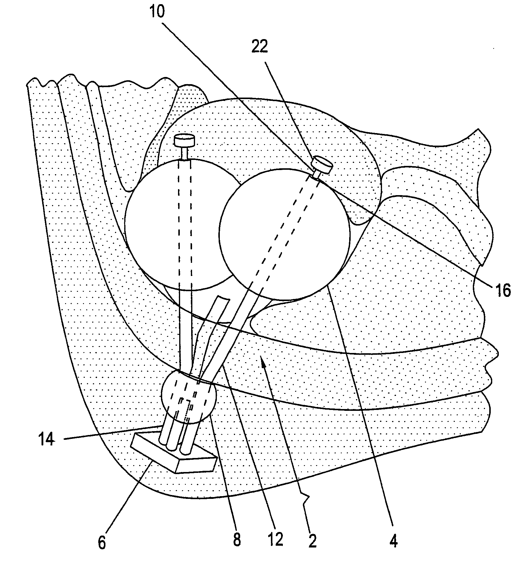 Compressive device for percutaneous treatment of obesity