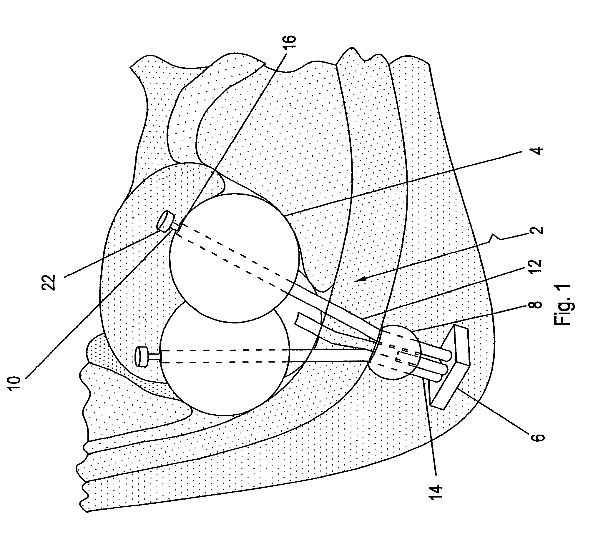 Compressive device for percutaneous treatment of obesity