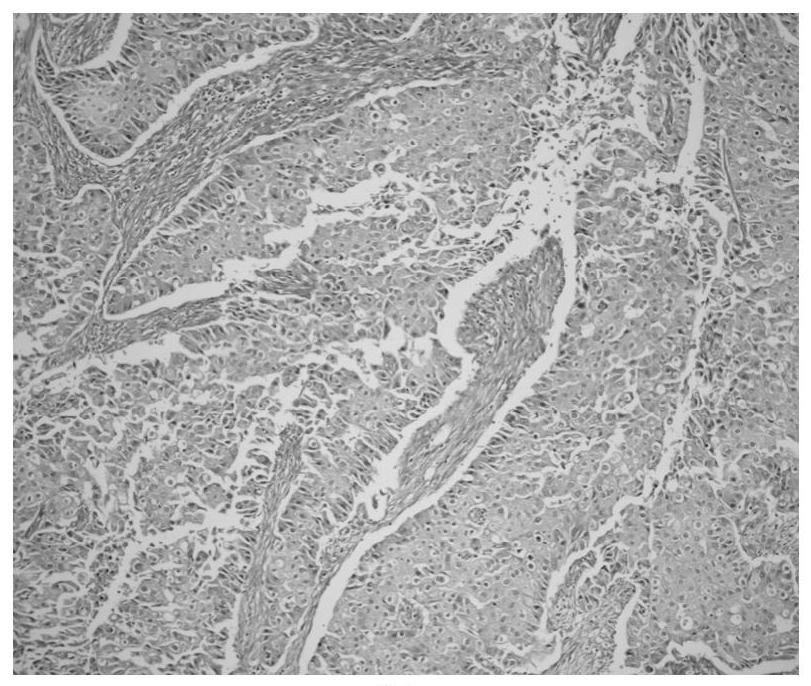 Immunohistochemical kit for rapidly identifying lung cancer and sclerotic lung cytoma during operation