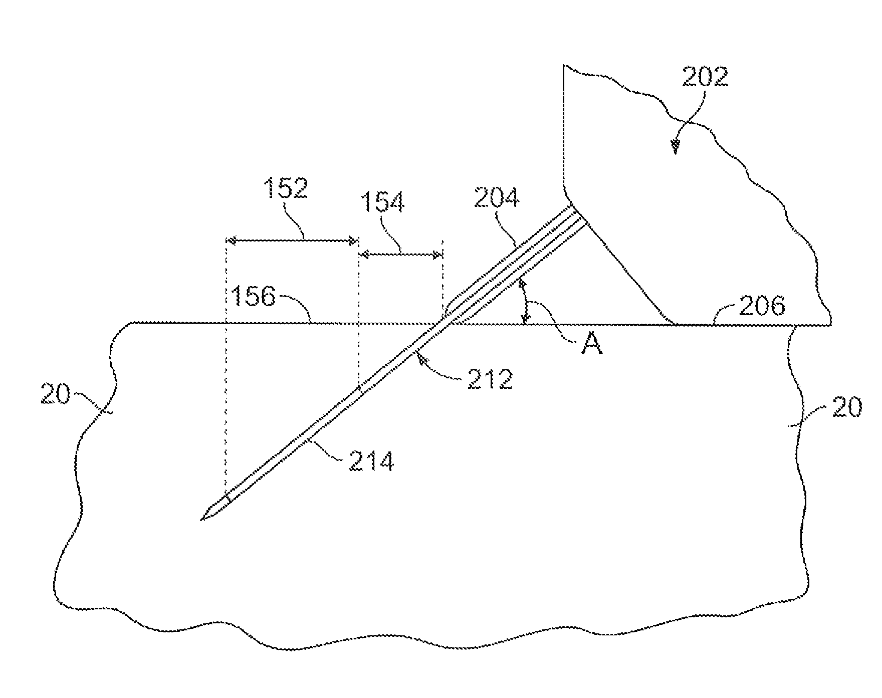 Methods and devices for treating tissue