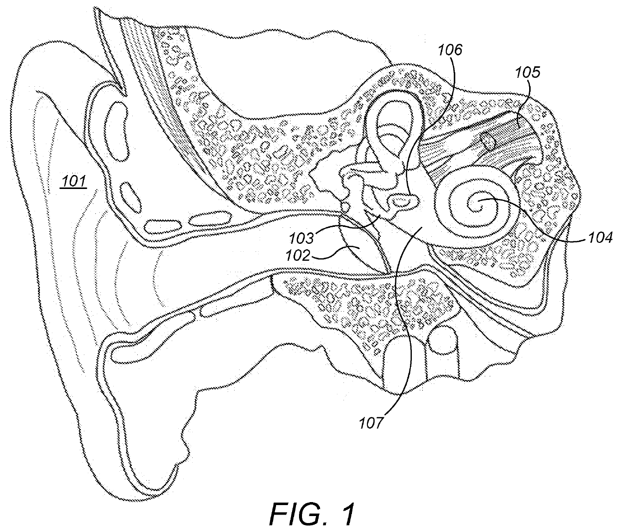 Passive Hearing Implant