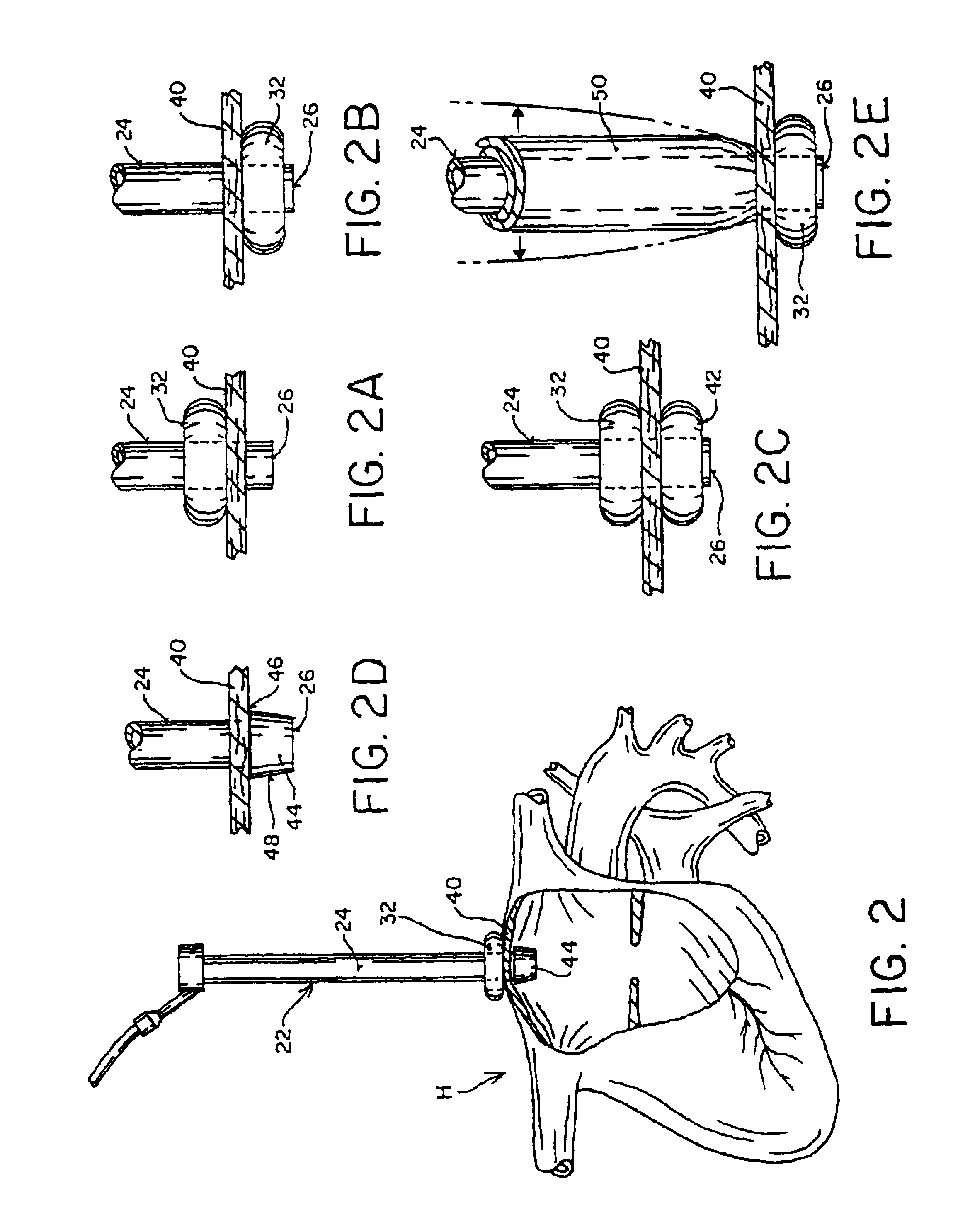 Method and apparatus for thoracoscopic intracardiac procedures