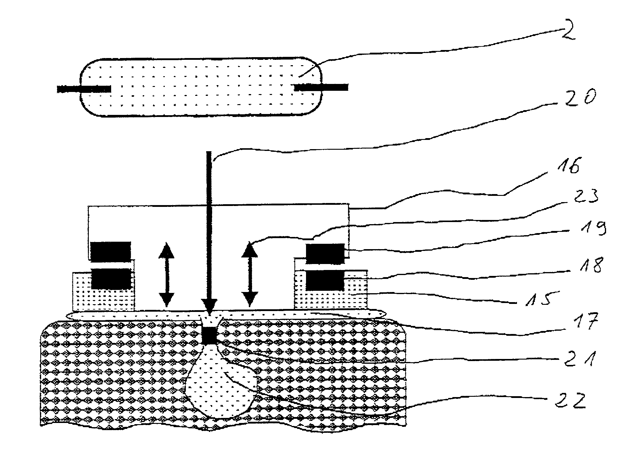 Irradiation device and method for the treatment of acne and acne scars