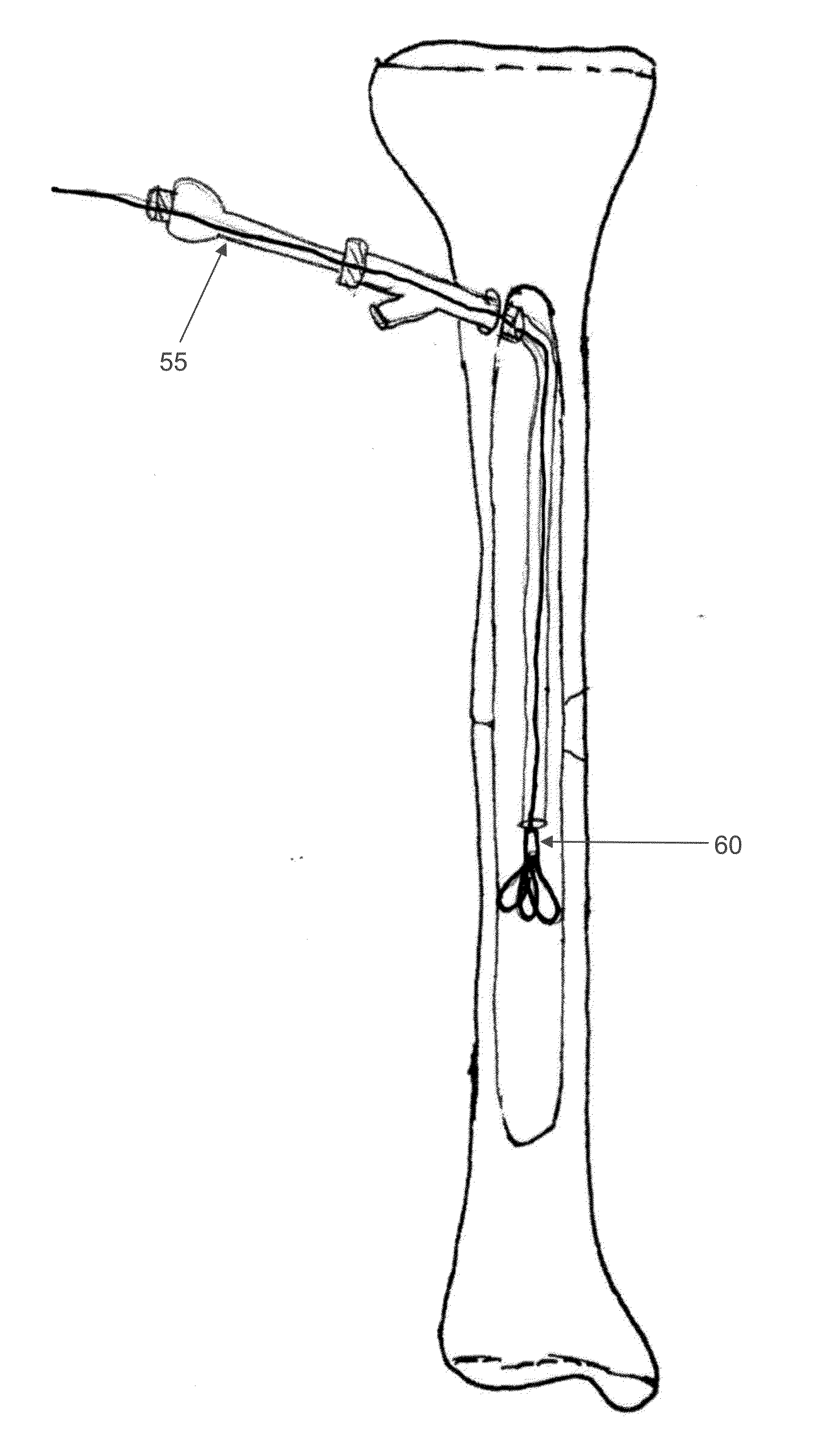 Method and apparatus for treating bone fractures, and/or for fortifying and/or augmenting bone, including the provision and use of composite implants