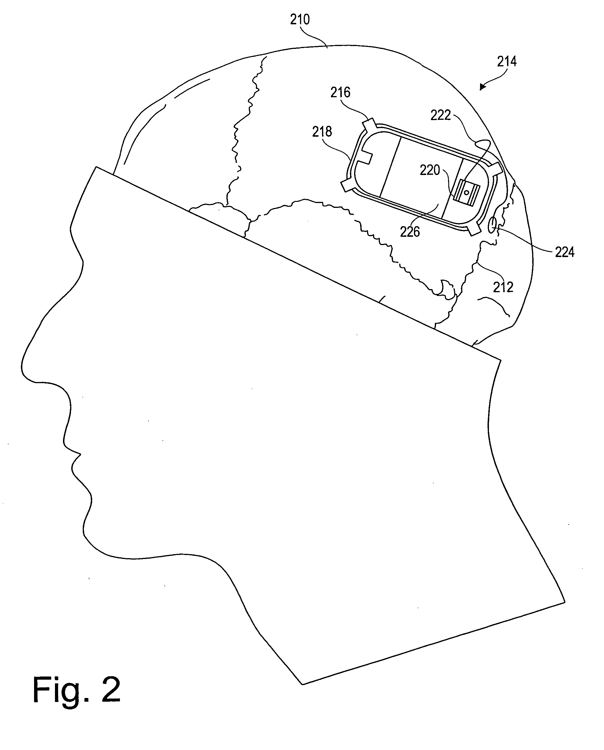 System and method for controlling neurological disorders with spatially separated detection and therapy locations