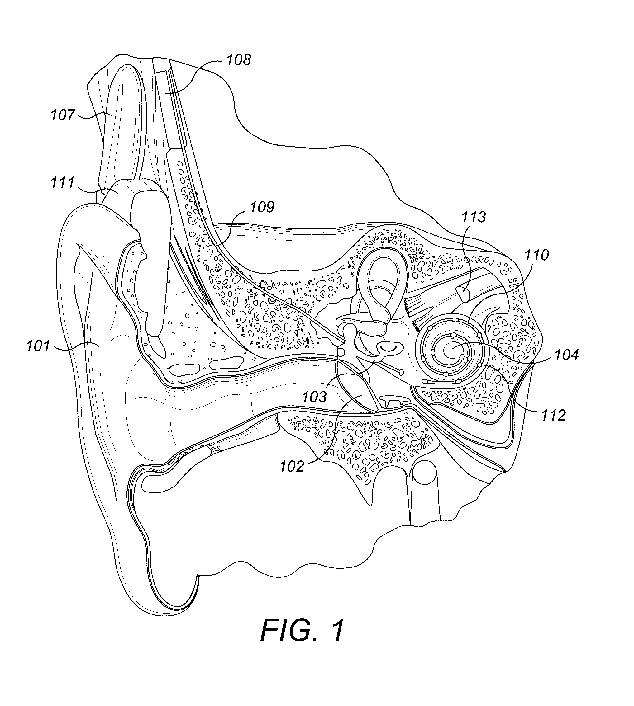 Electrode Lead that Avoids Electrode Array Migration from the Cochlea