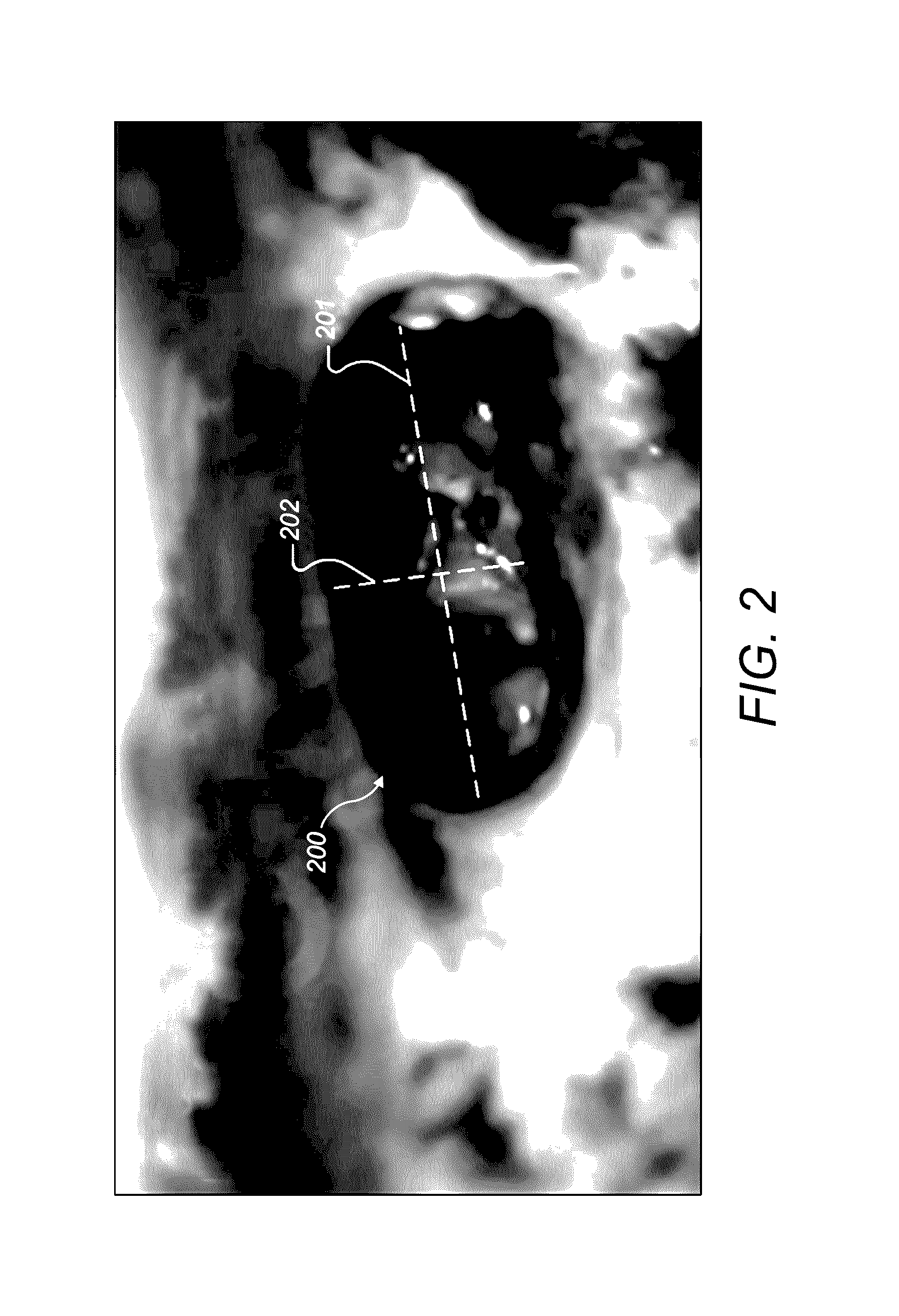 Electrode Lead that Avoids Electrode Array Migration from the Cochlea