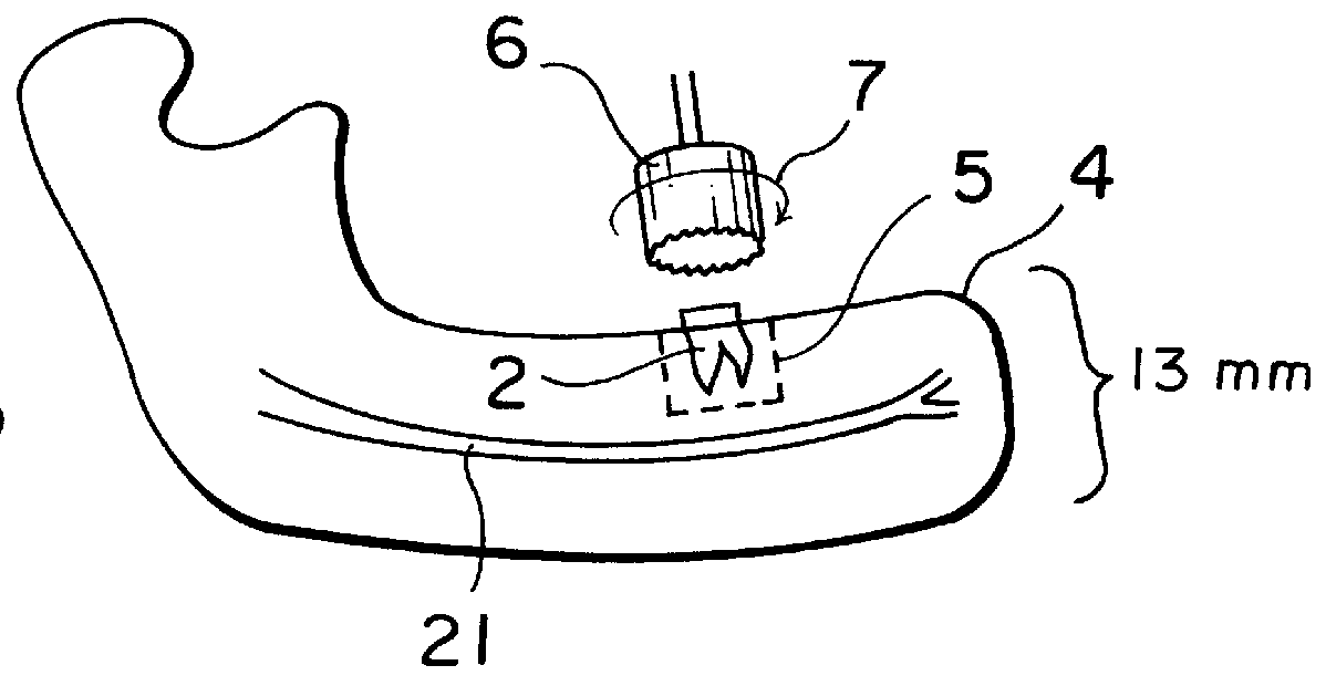 Tooth implant and method for implantation