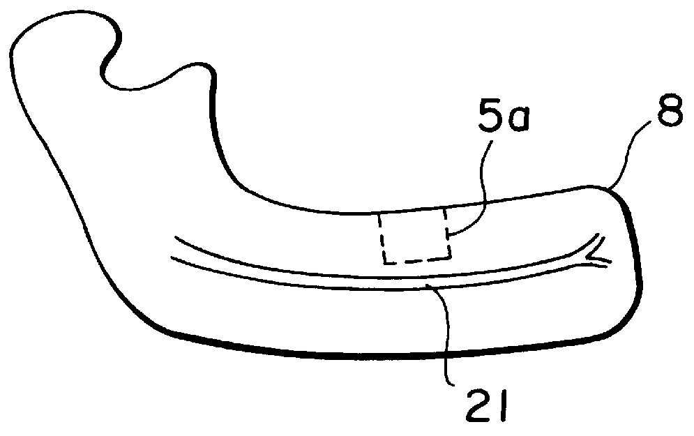 Tooth implant and method for implantation