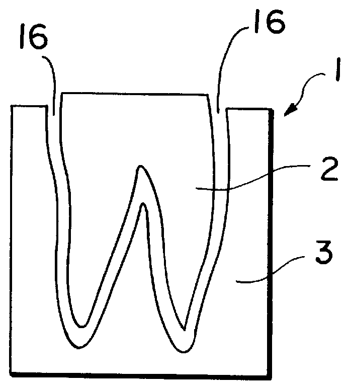 Tooth implant and method for implantation