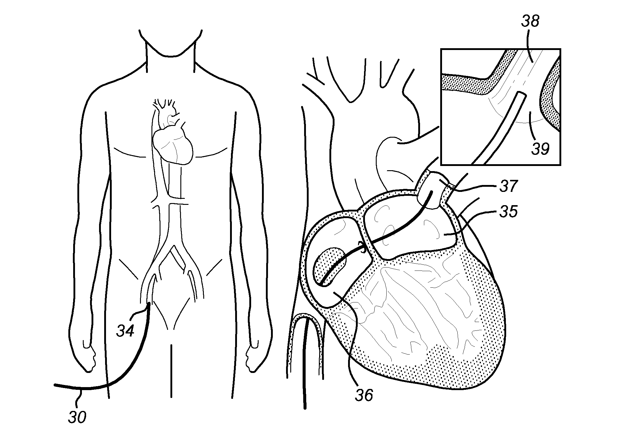 System, device and method for ablation of a vessel's wall from the inside