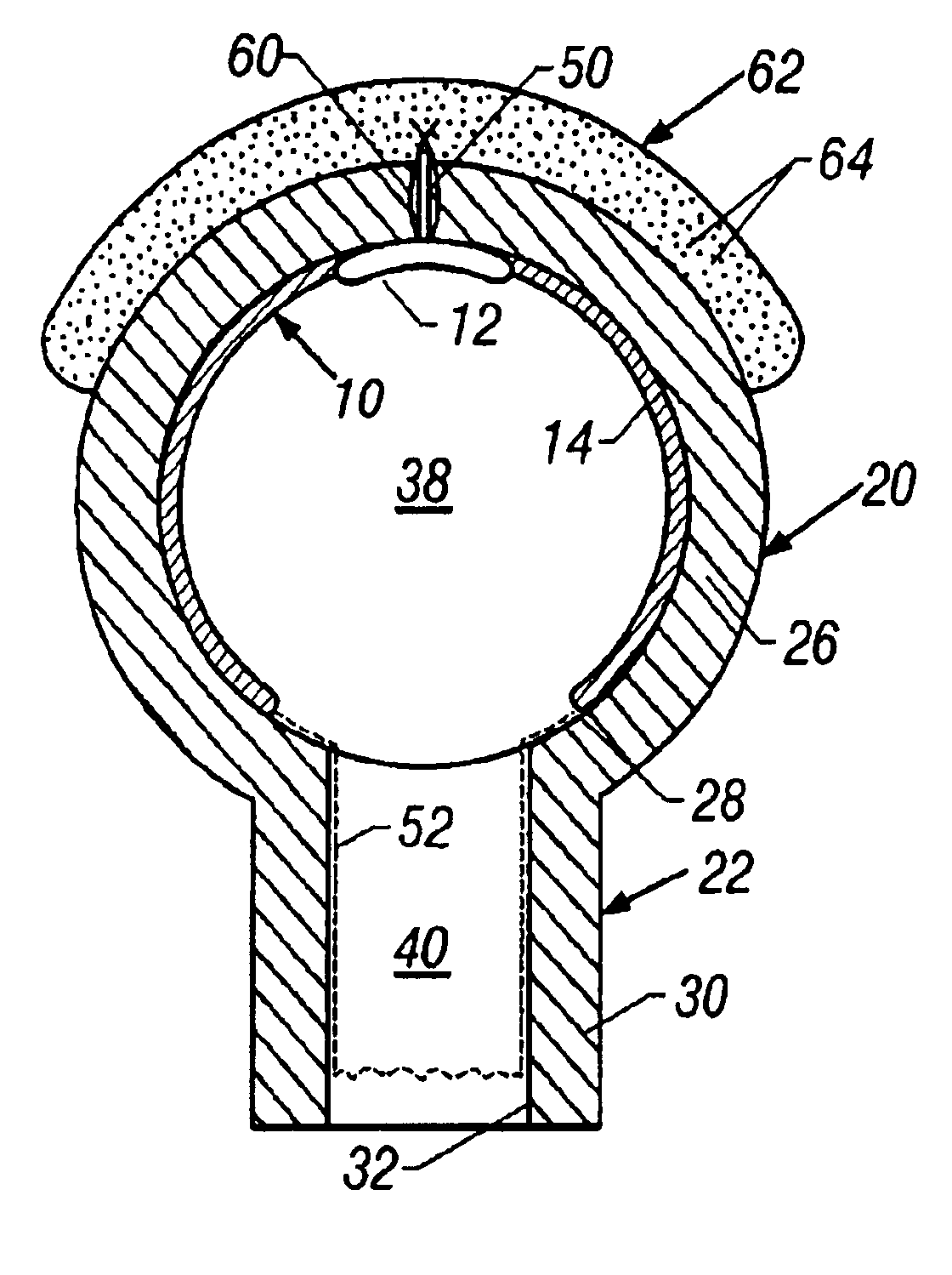 Method for surgically restoring coronary blood vessels