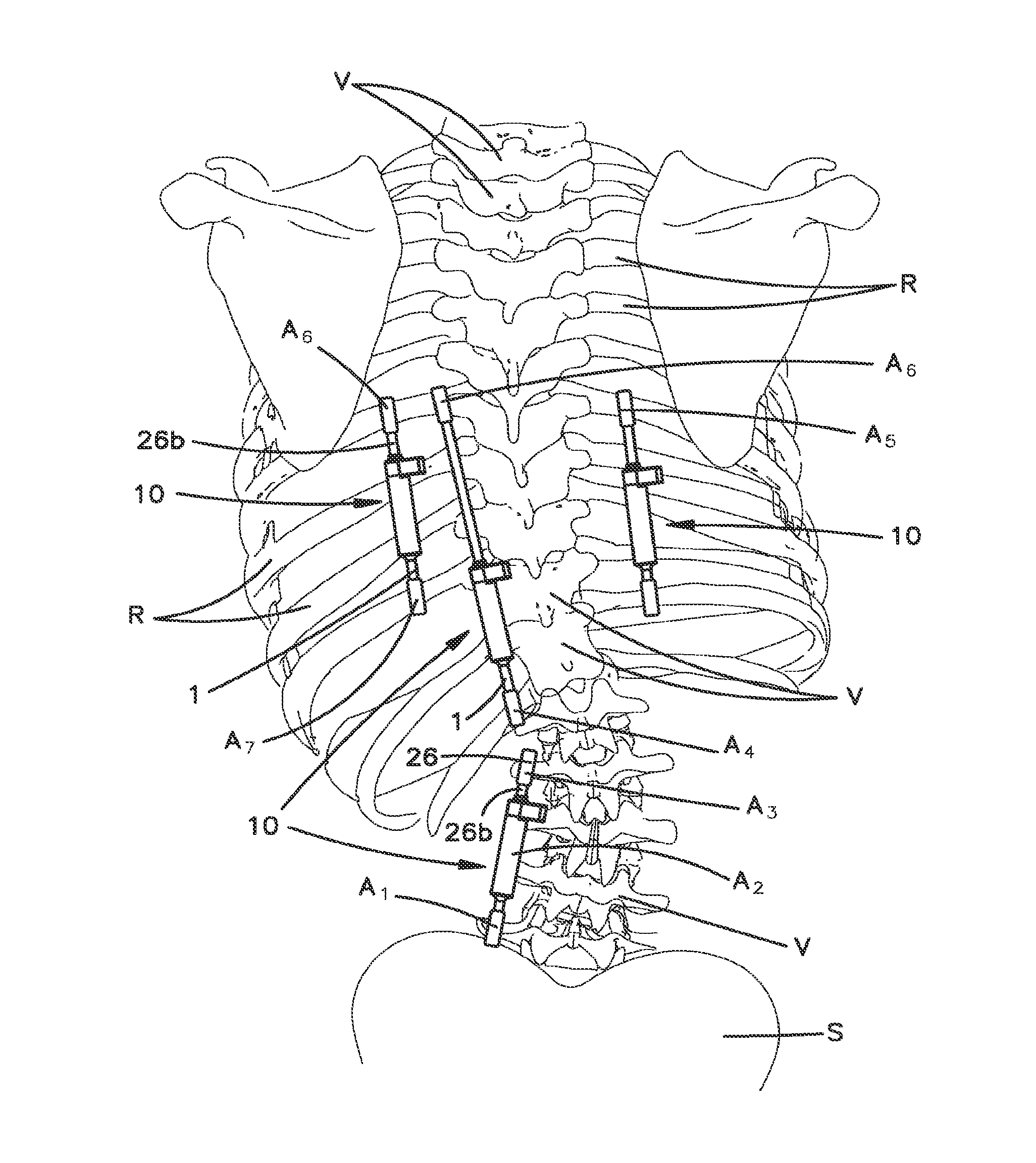 Non-fusion scoliosis expandable spinal rod