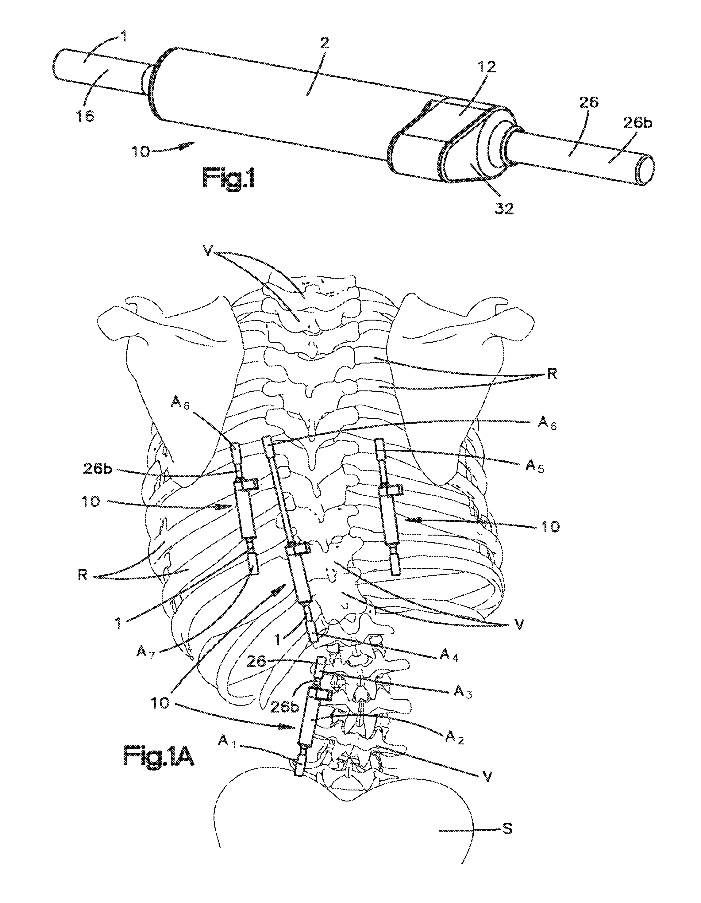 Non-fusion scoliosis expandable spinal rod