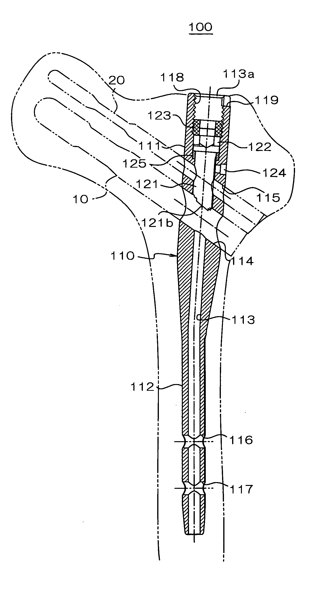 Intramedullary nail