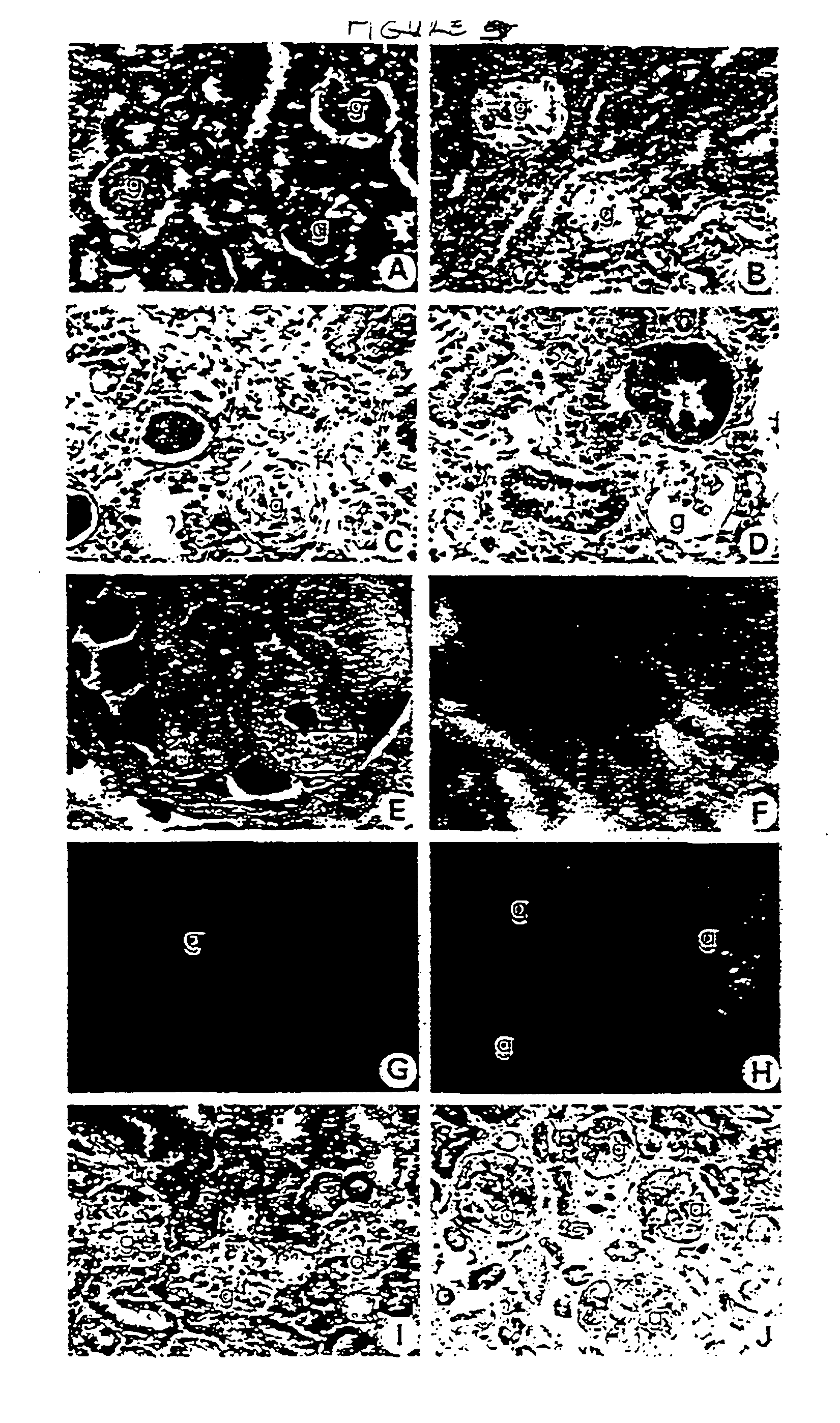 Recombinant human uteroglobin in treatment of inflammatory and fibrotic conditions