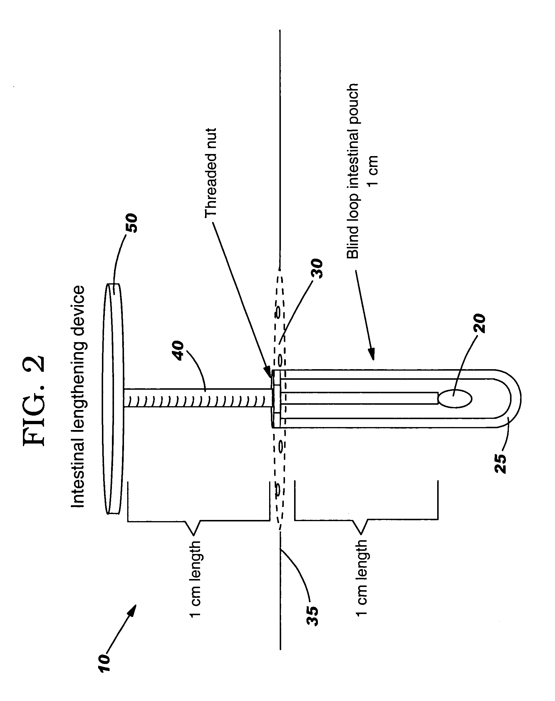 Essentially tubular body passage lengthening device and method