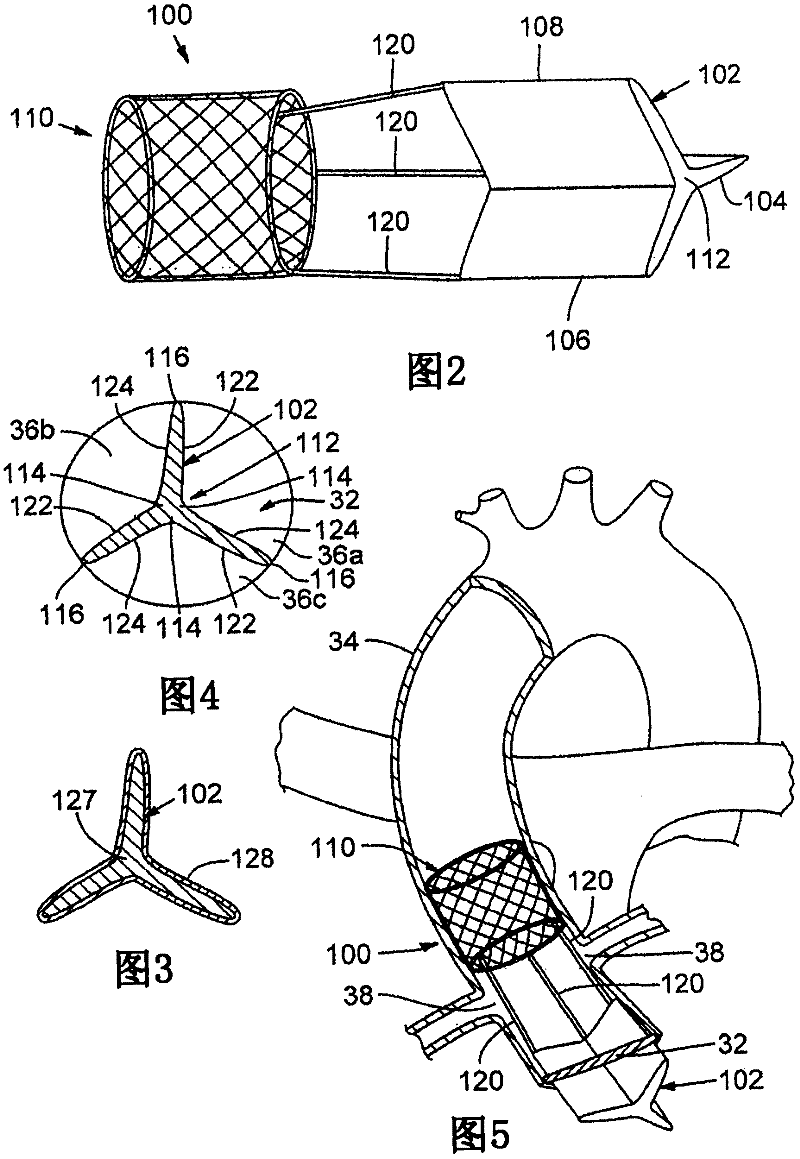 Artificial inserts to improve heart valve function