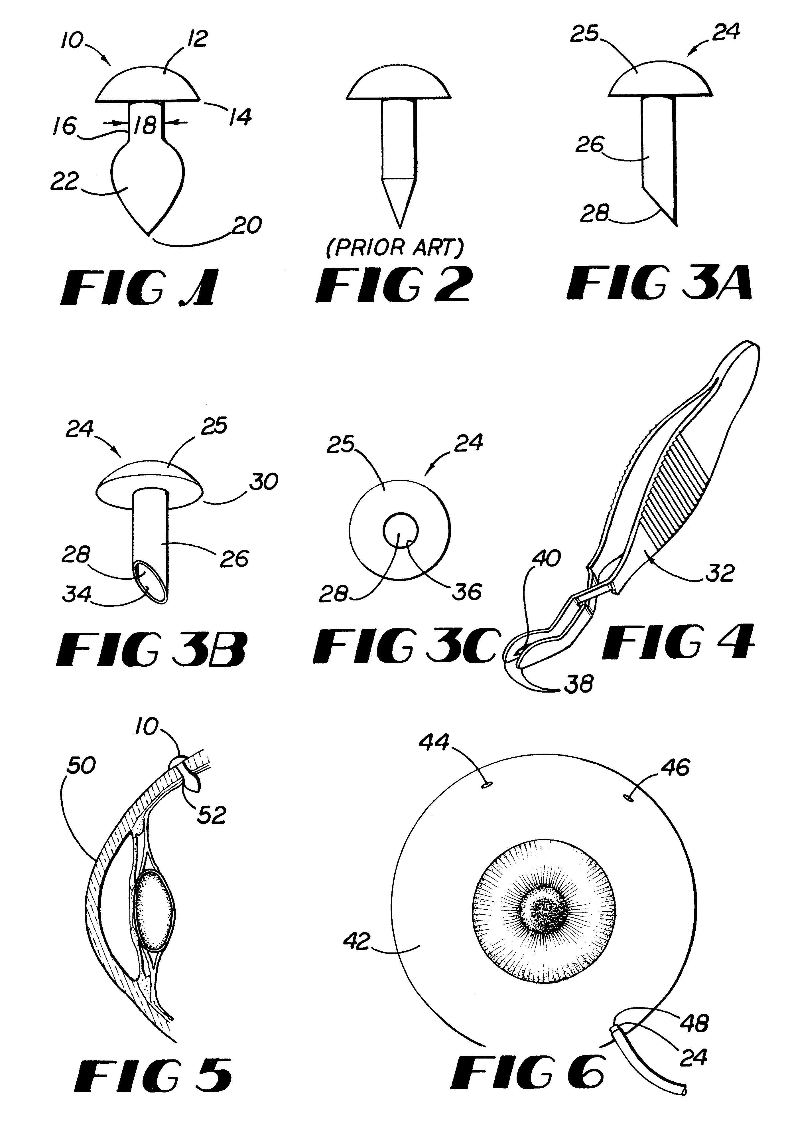 Scleral plug system