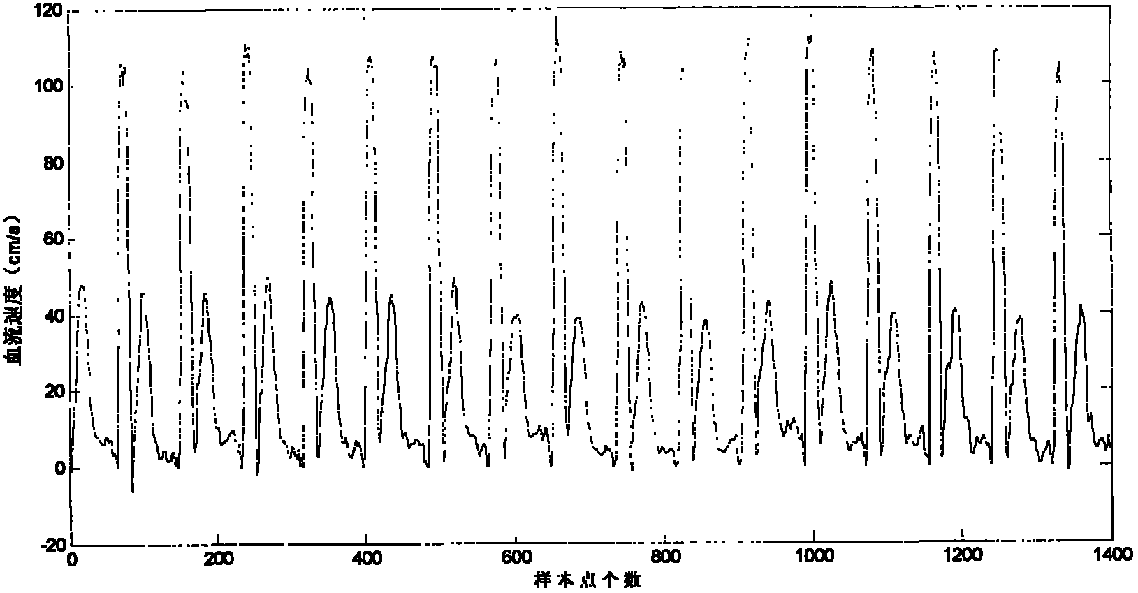 A method for real-time analysis of ultrasonic blood flow signal quality