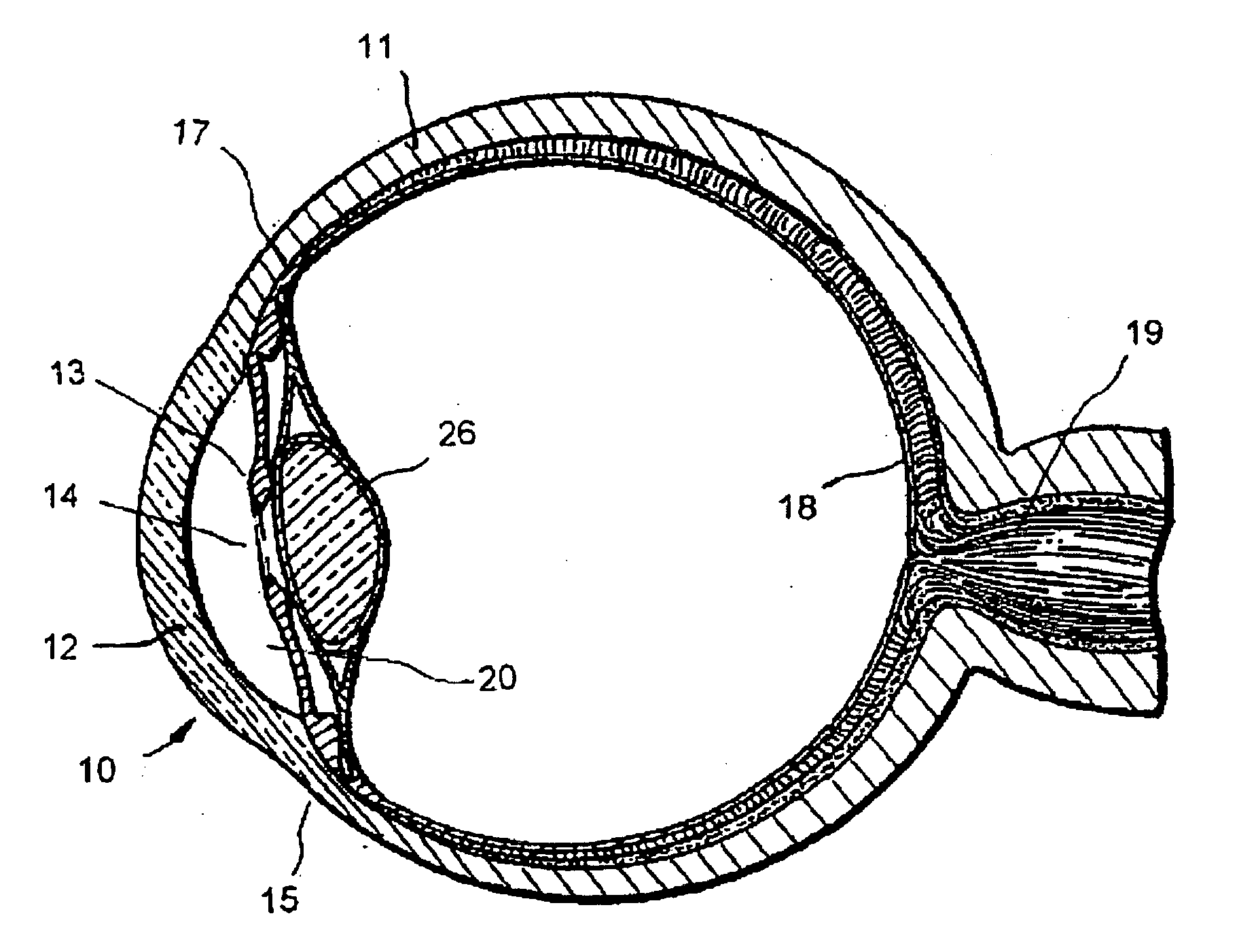 Method of treating glaucoma using an implant having a uniform diameter between the anterior chamber and Schlemm's canal