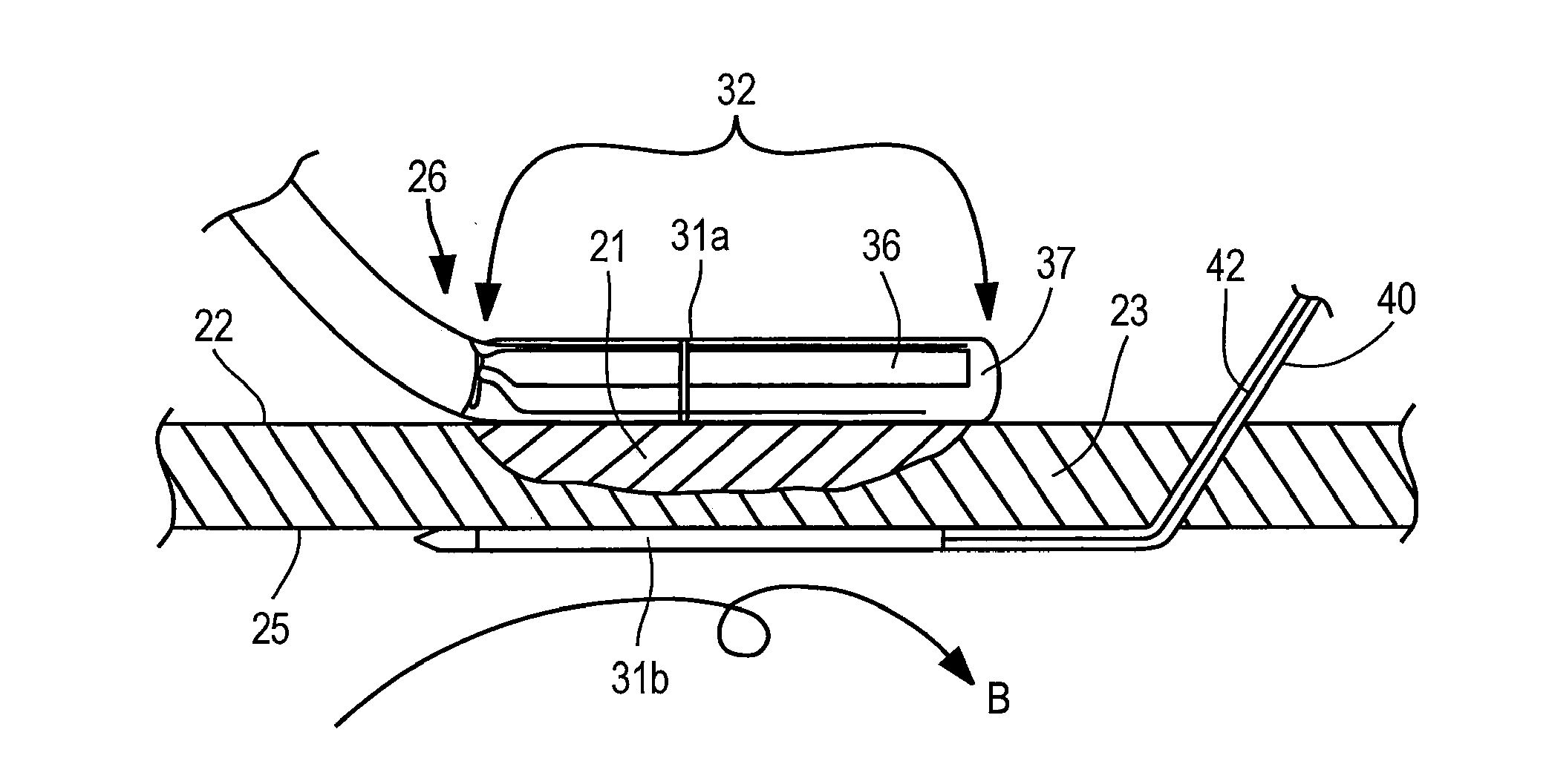 Apparatus and Method For Assessing Transmurality of a Tissue Ablation