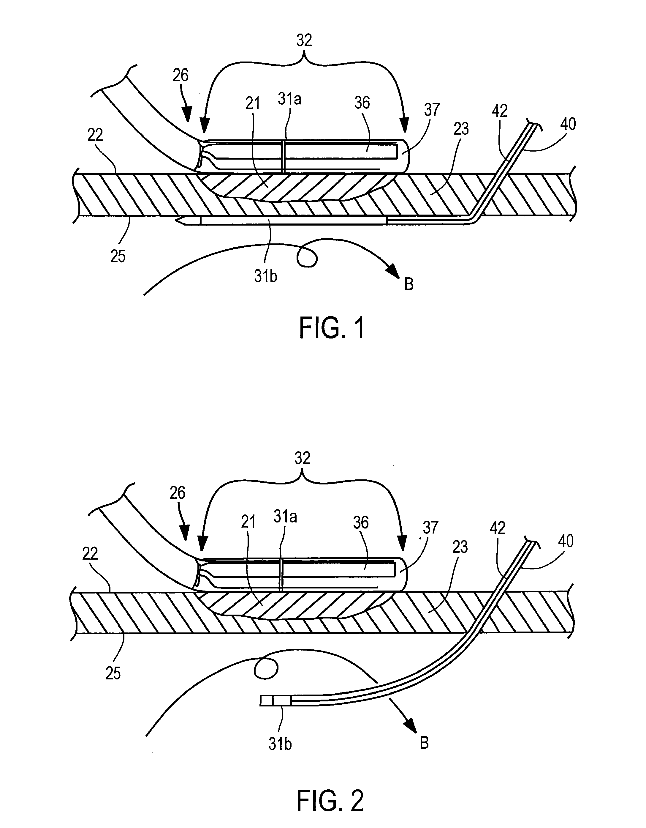 Apparatus and Method For Assessing Transmurality of a Tissue Ablation