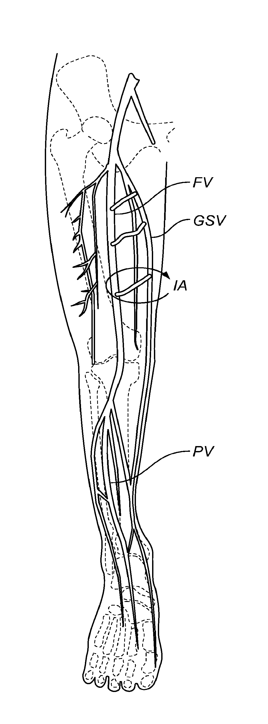 Methods, Devices and Systems for Treating Venous Insufficiency