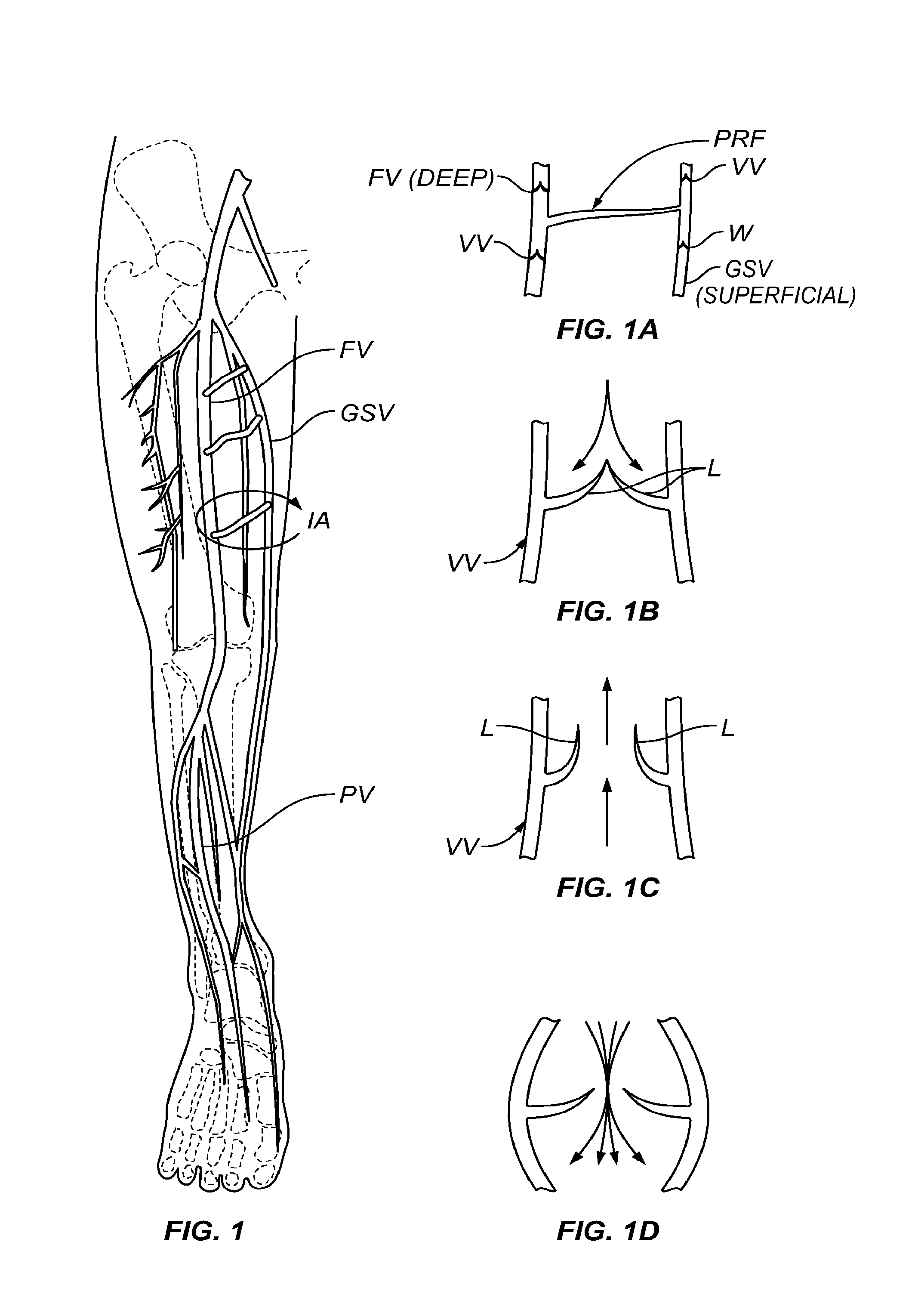 Methods, Devices and Systems for Treating Venous Insufficiency