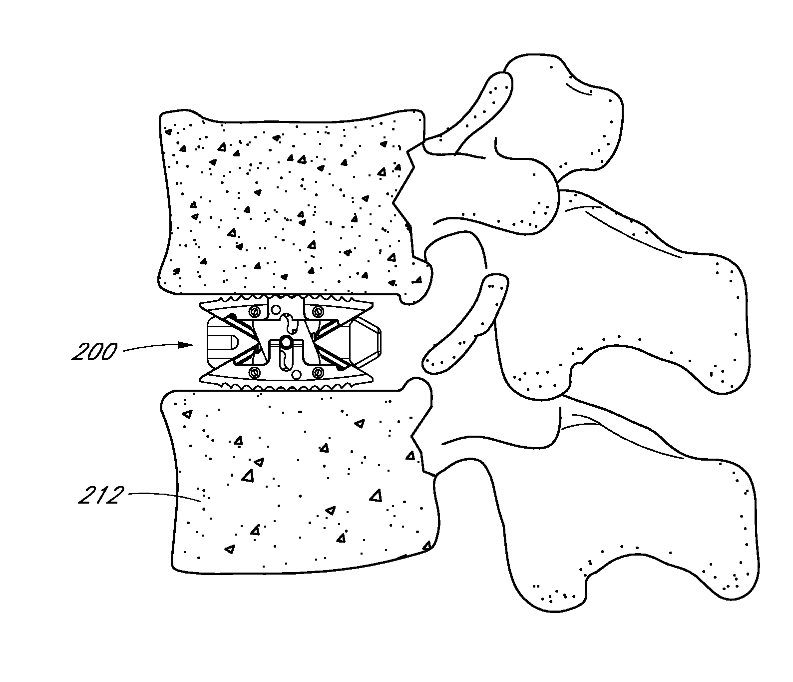 Intervertebral implant