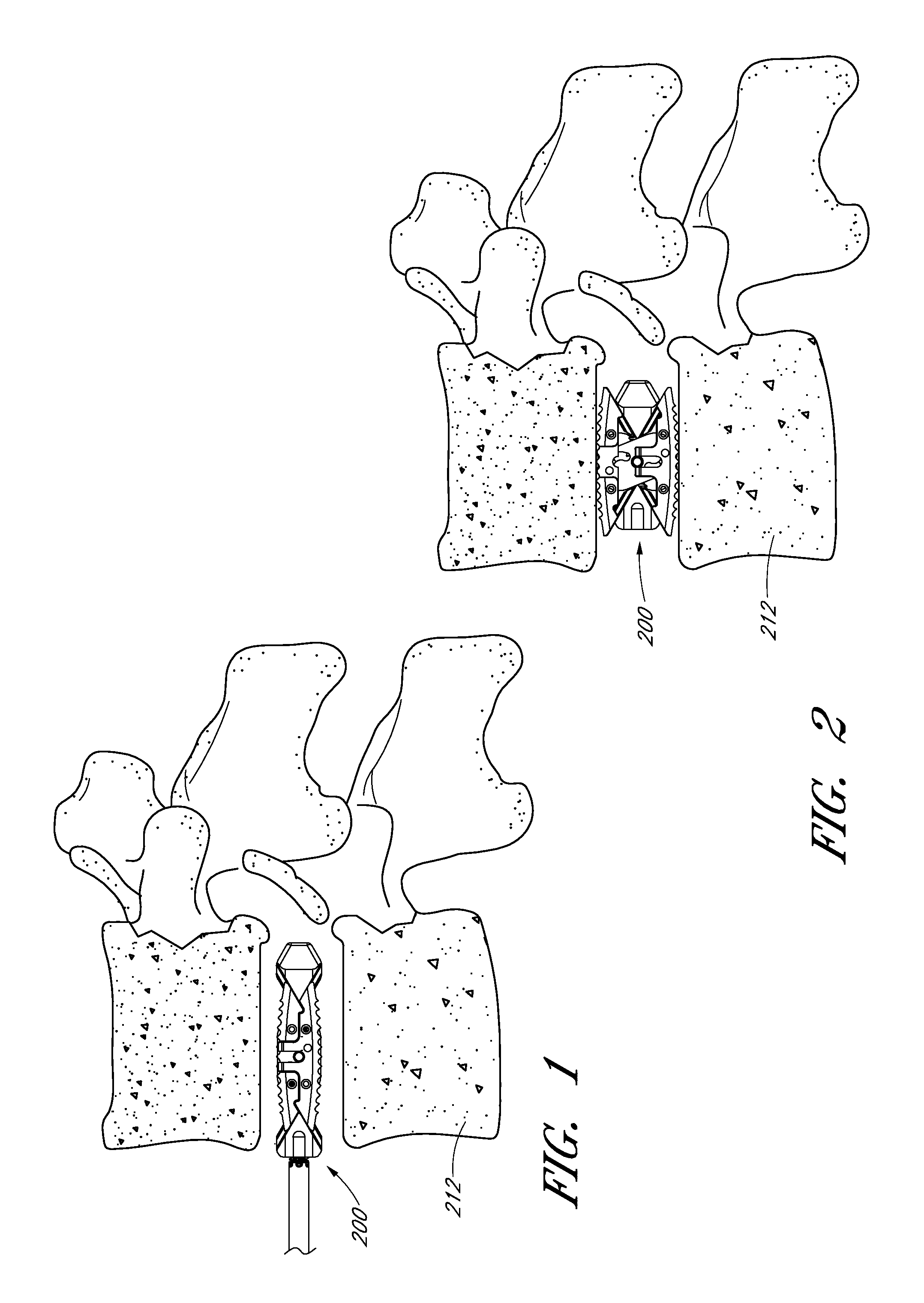 Intervertebral implant