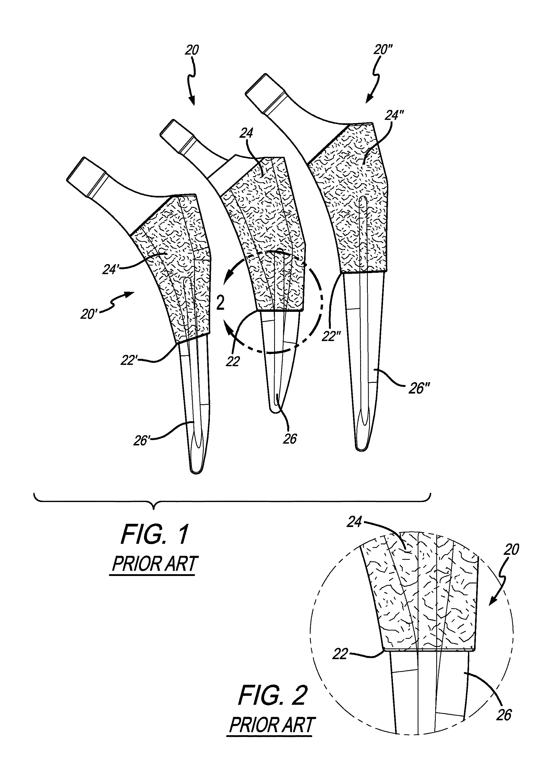 Femoral stem with partially recessed porous coating